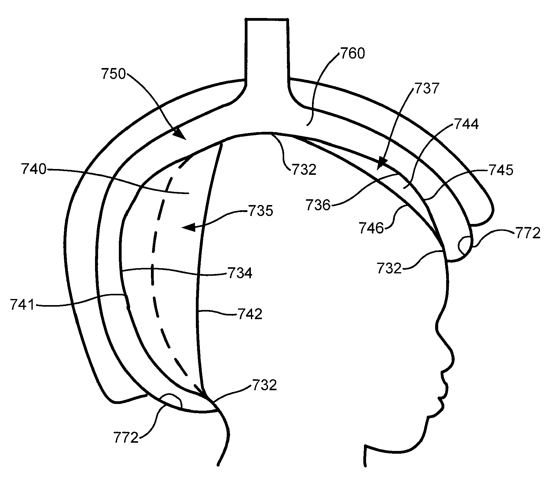 In situ molded orthotic and method for its fabrication