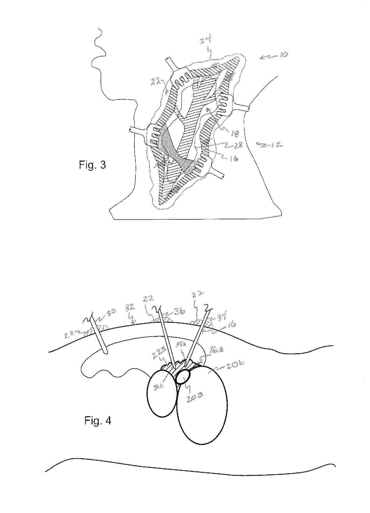 Implantable drug eluting system and method of use