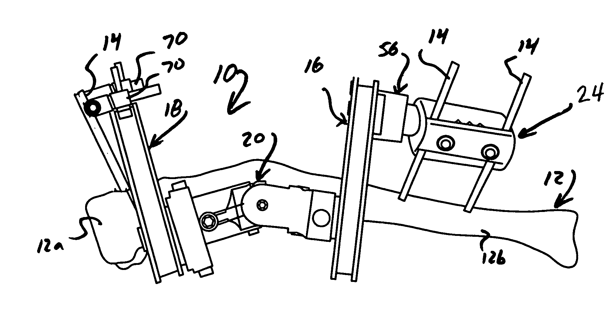 Method and apparatus for the external fixation and correction of bone