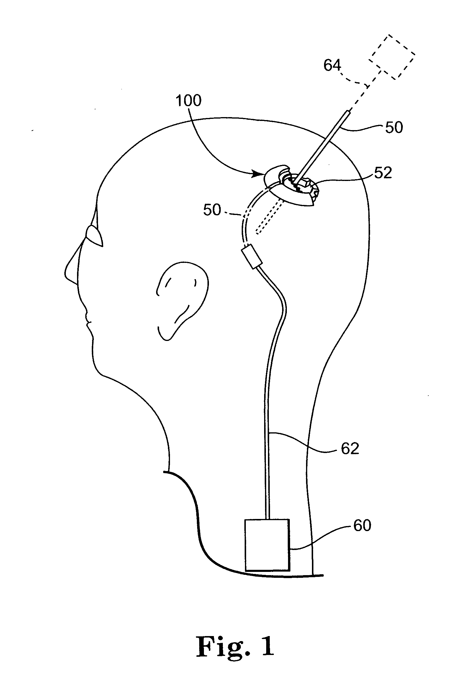 Methods and apparatus for securing a therapy delivery device within a burr hole