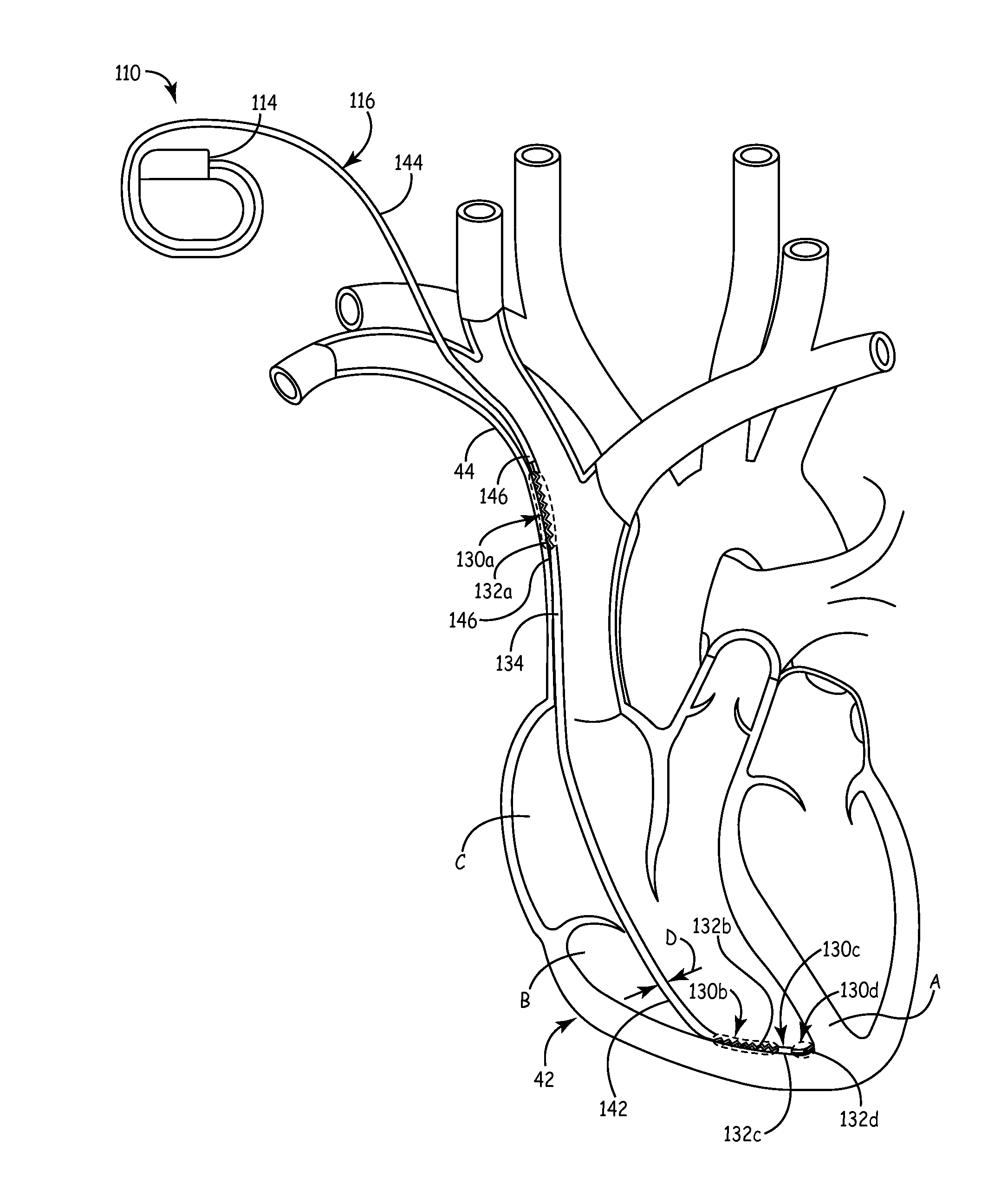 System and method for cardiac lead