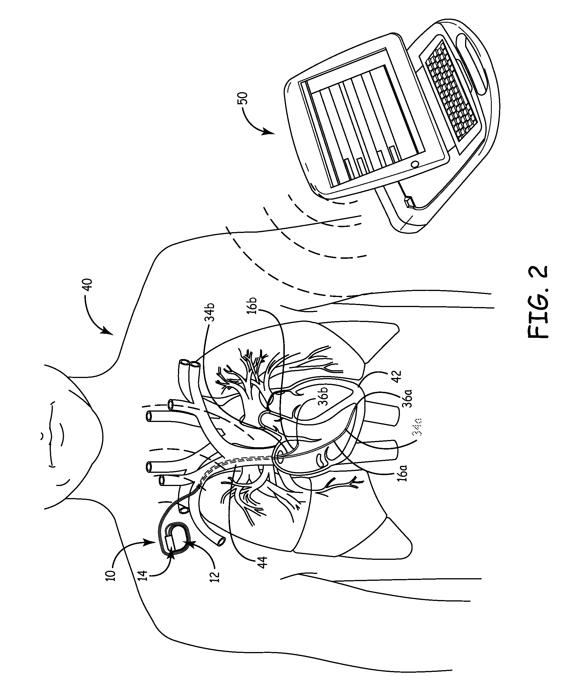 System and method for cardiac lead