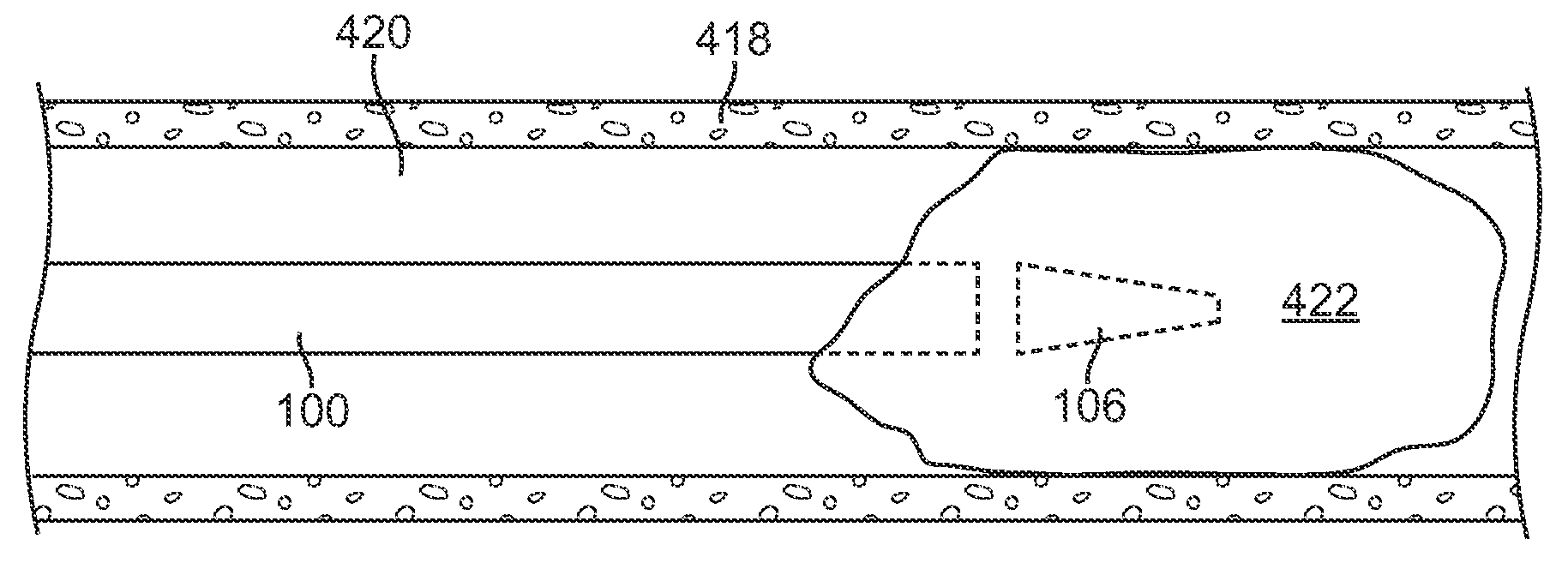 Catheter Having a Detachable Tip