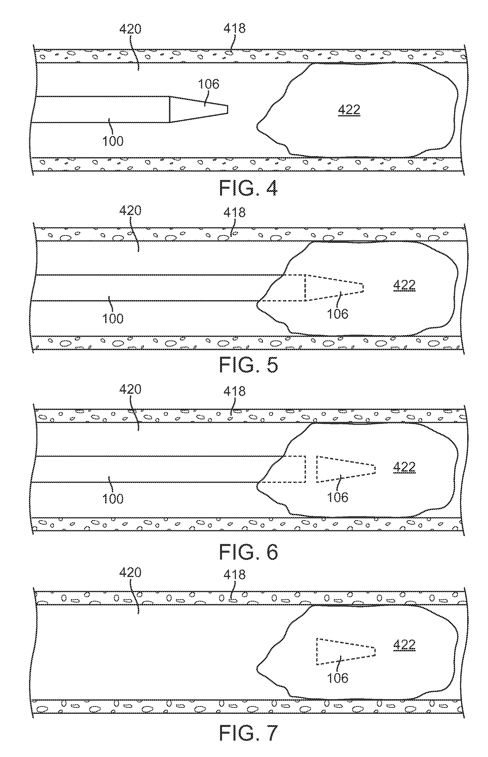 Catheter Having a Detachable Tip