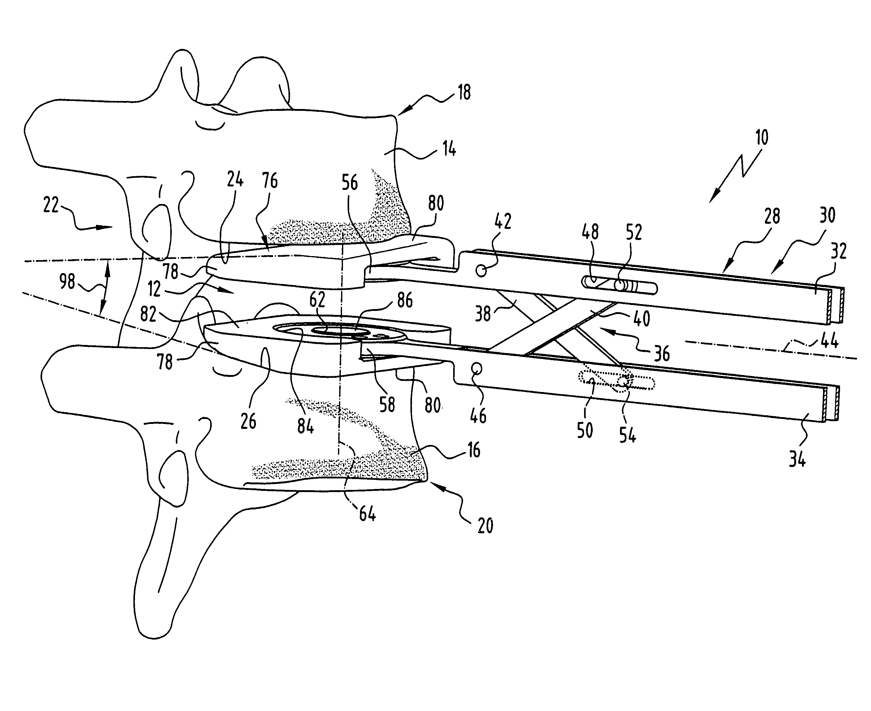 Surgical instrument for determining the size of intervertebral implant