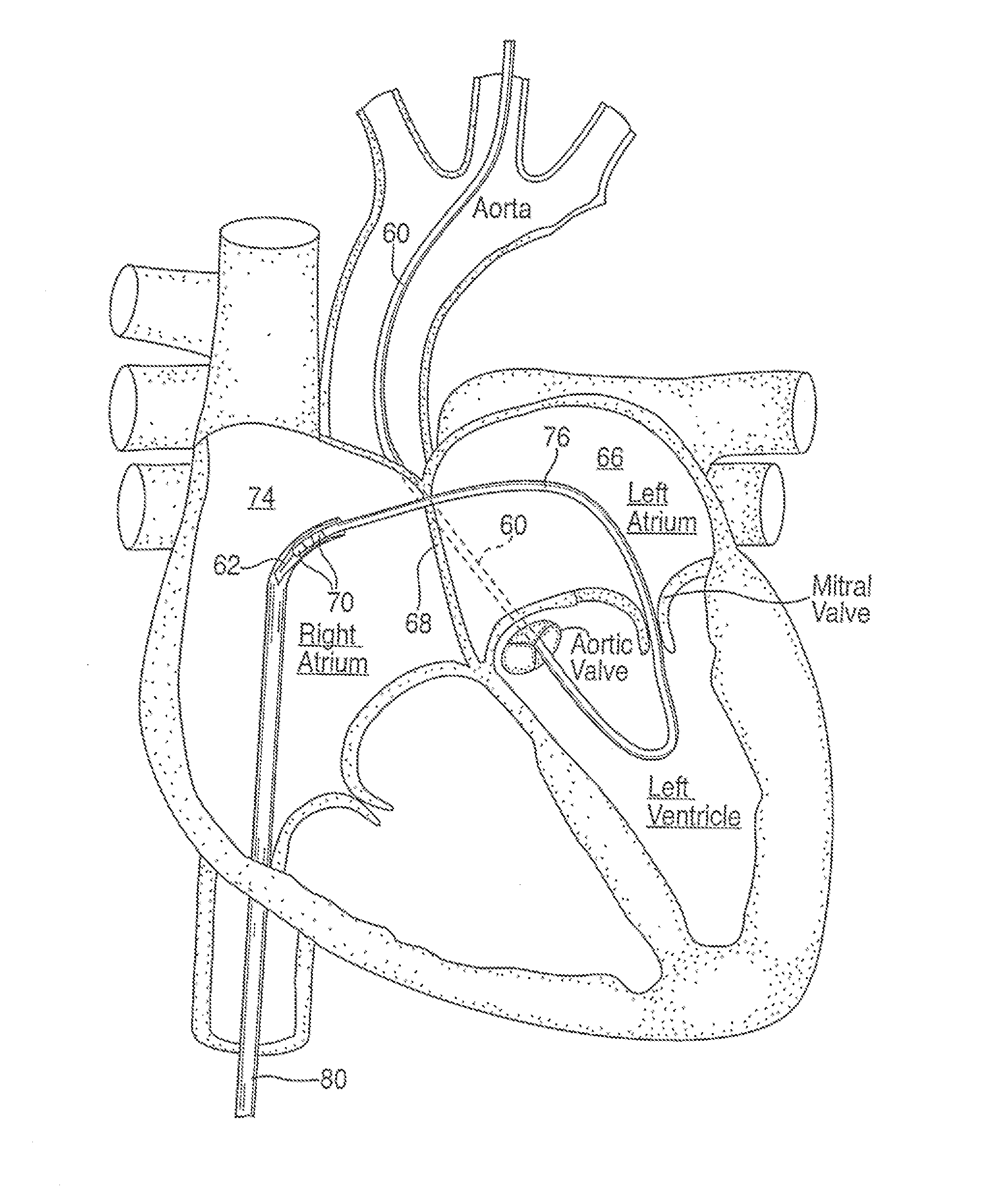 Apparatus for safe performance of transseptal technique and placement and positioning of an ablation catheter