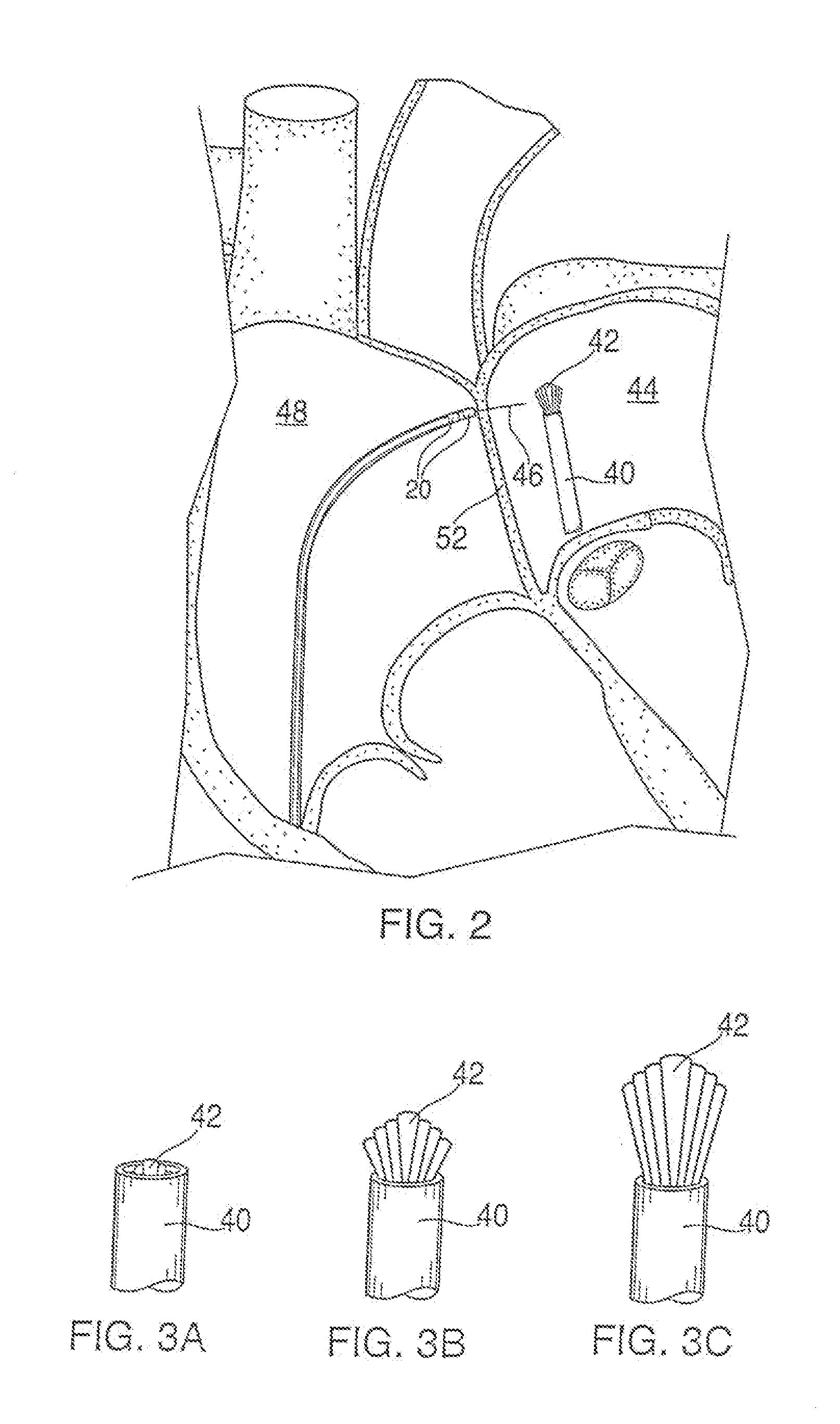 Apparatus for safe performance of transseptal technique and placement and positioning of an ablation catheter