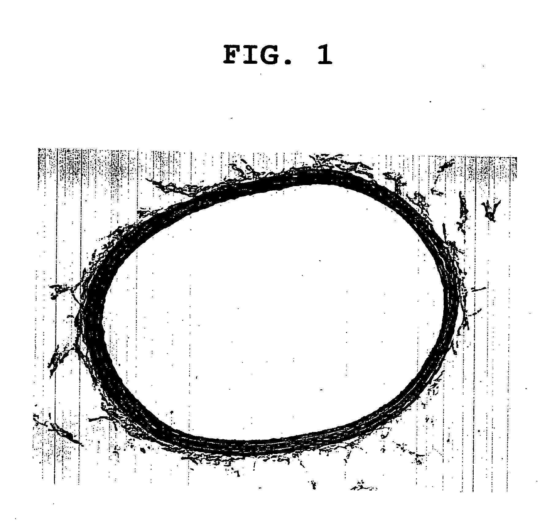 Agent for prophylaxis and treatment of angiostenosis