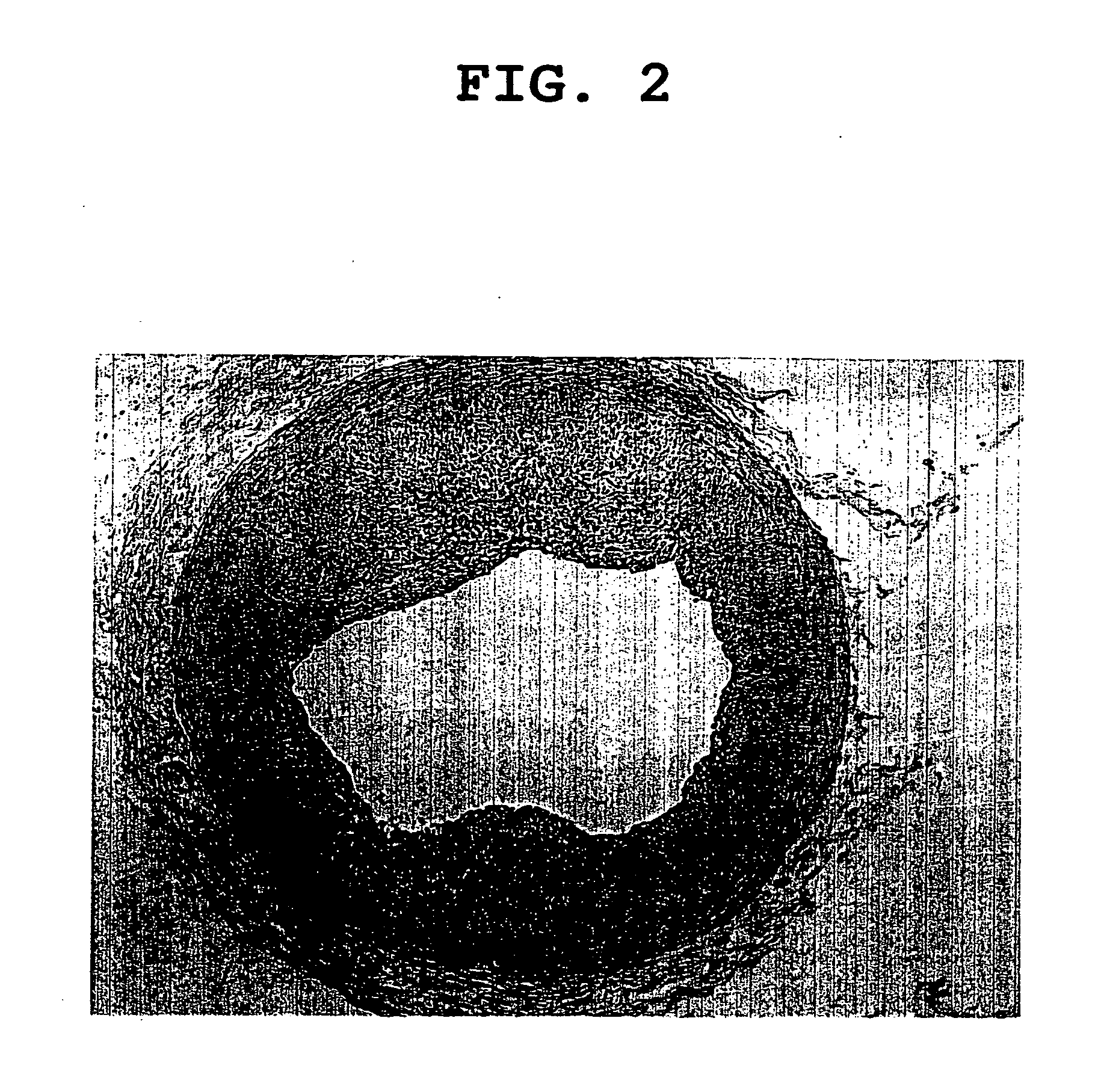 Agent for prophylaxis and treatment of angiostenosis