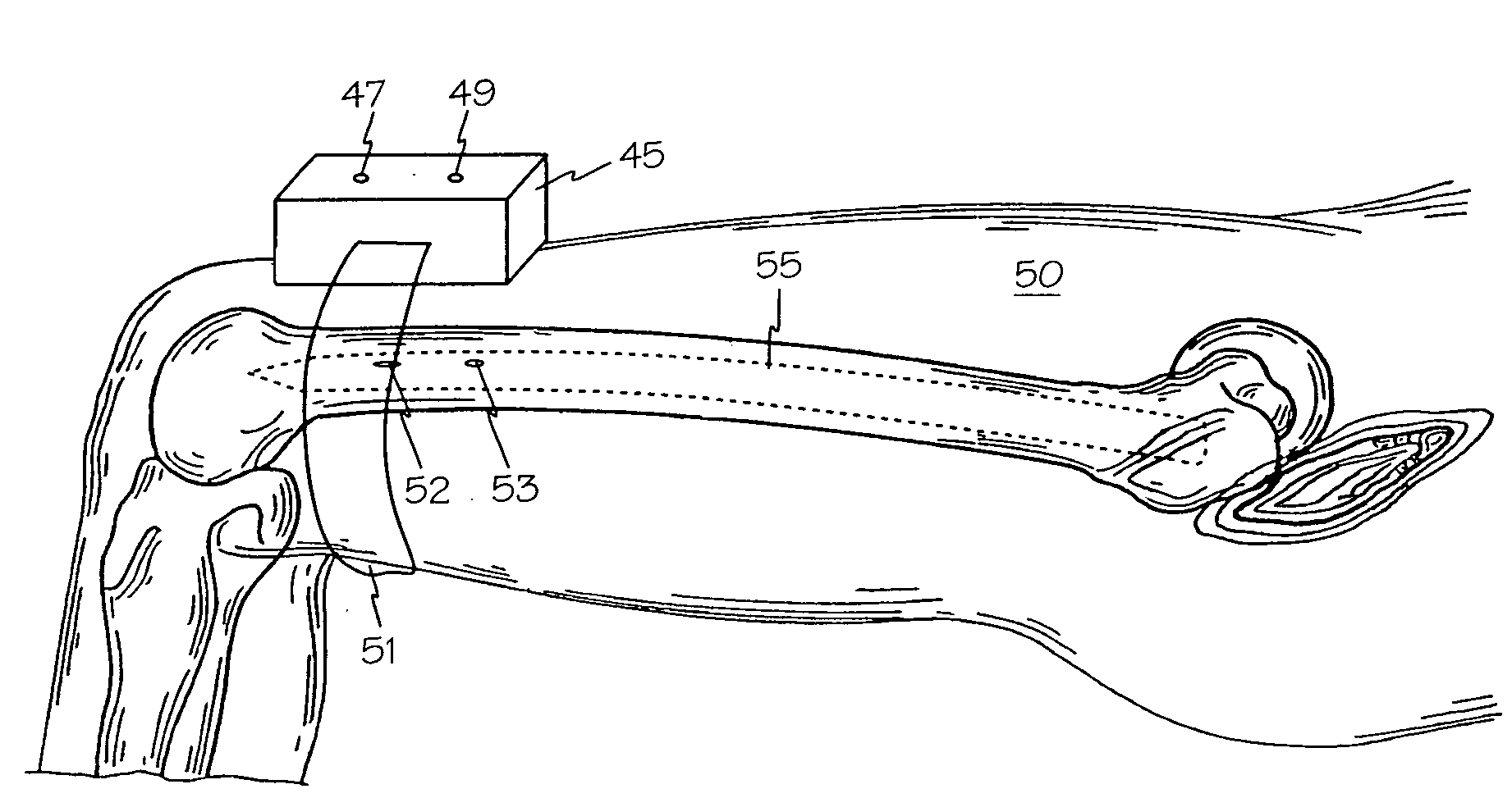 Method and apparatus for targeting blind holes in intramedullary rods