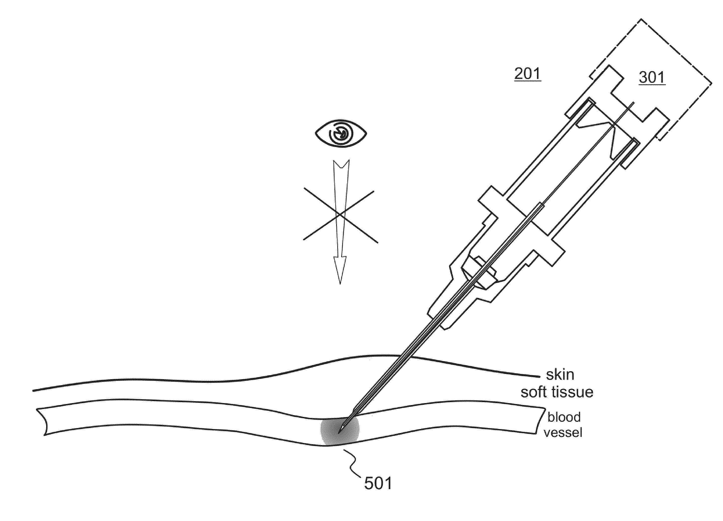 Intravascular Catheter Assembly