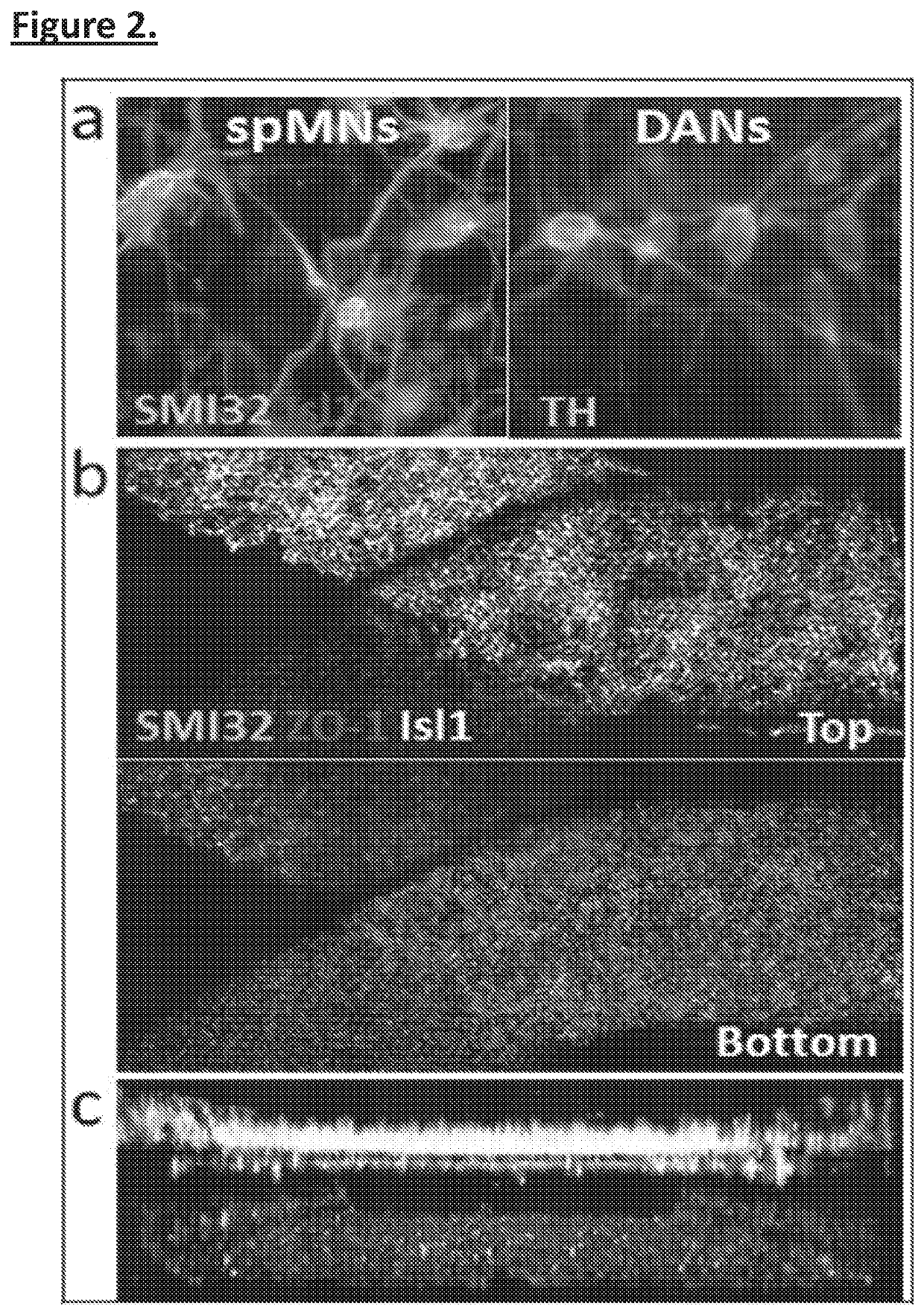 Human pluripotent stem cell derived neurodegenerative disease models on a microfluidic chip