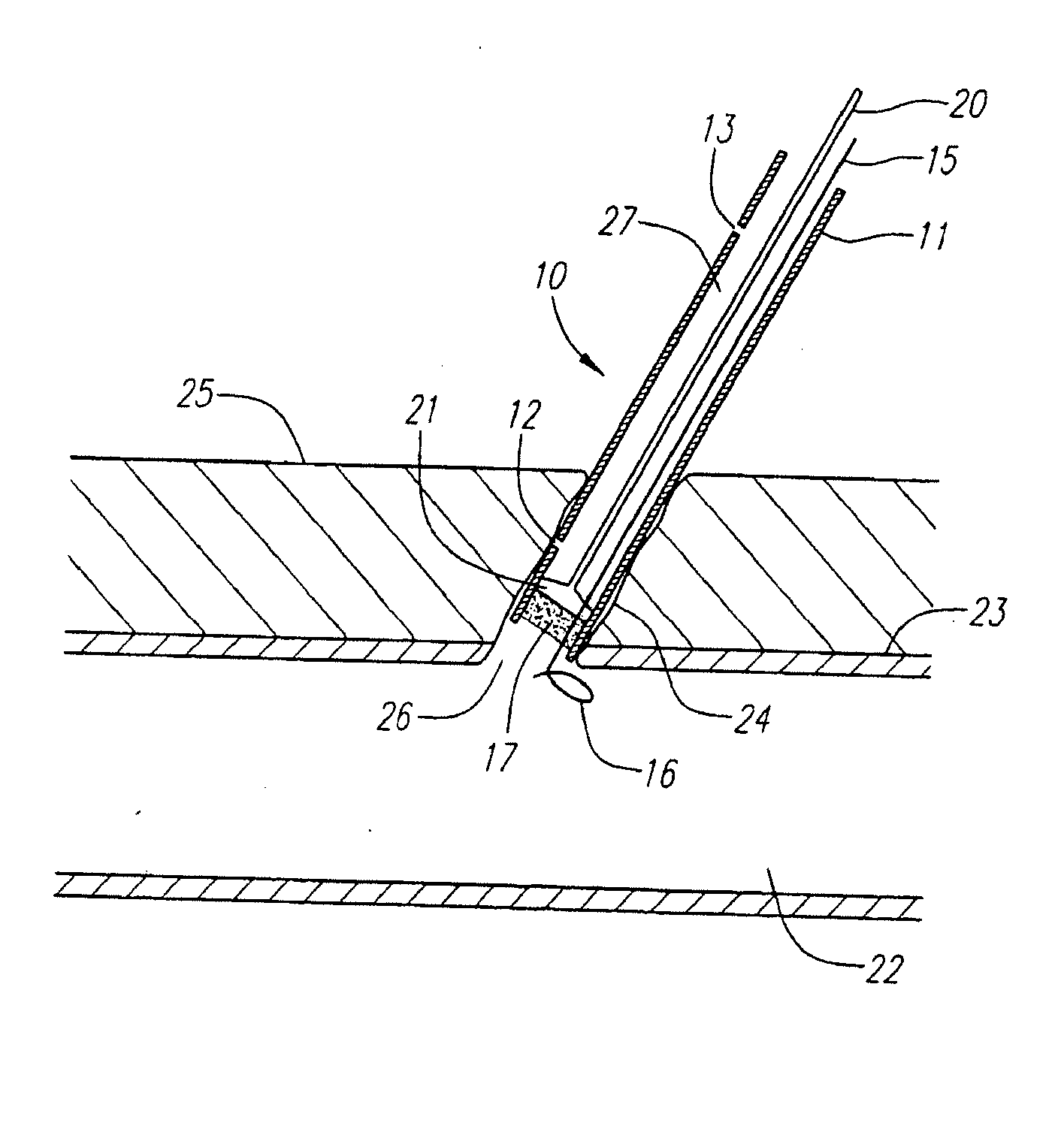 Locator and delivery device and method of use