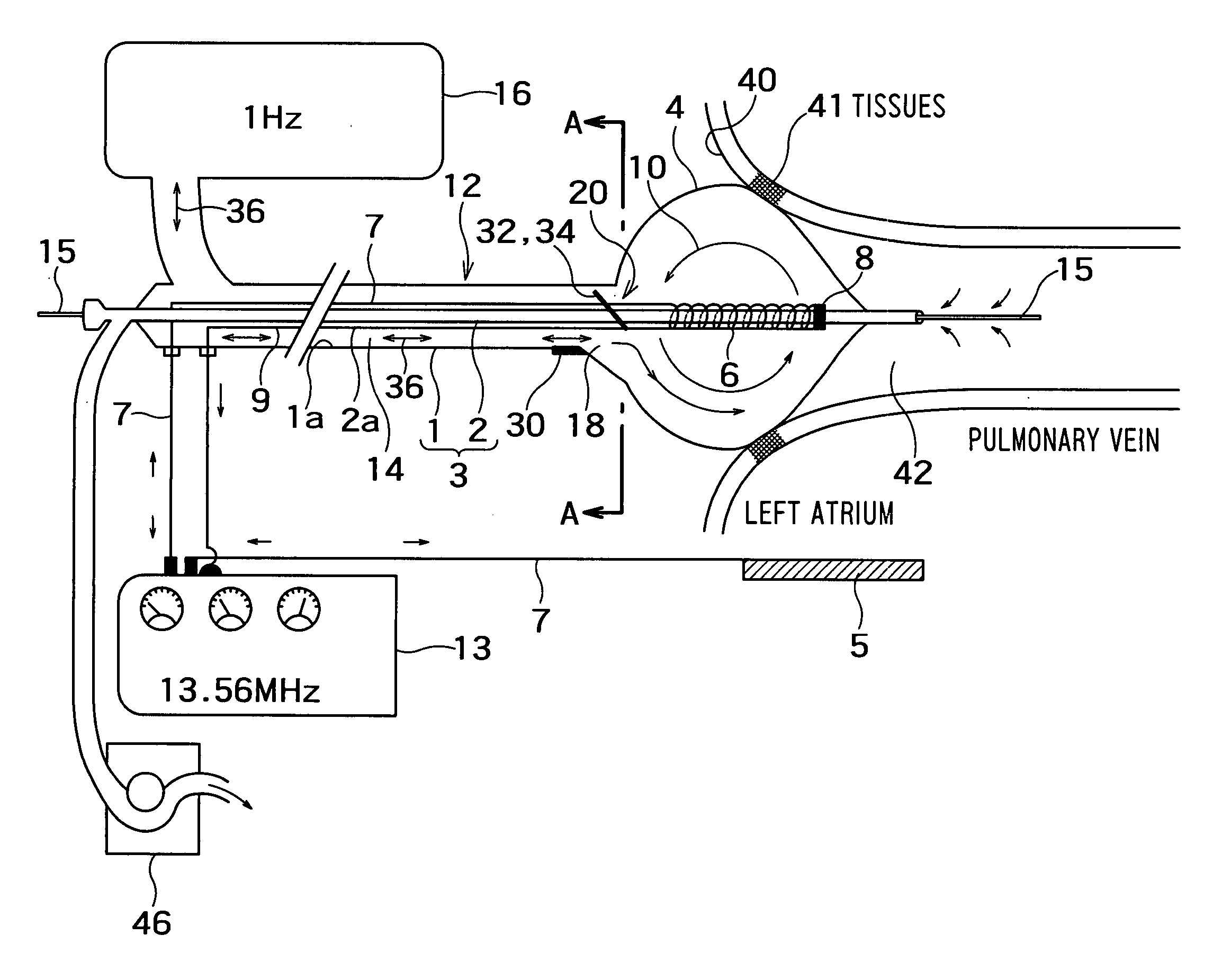 Radio-frequency thermal balloon catheter