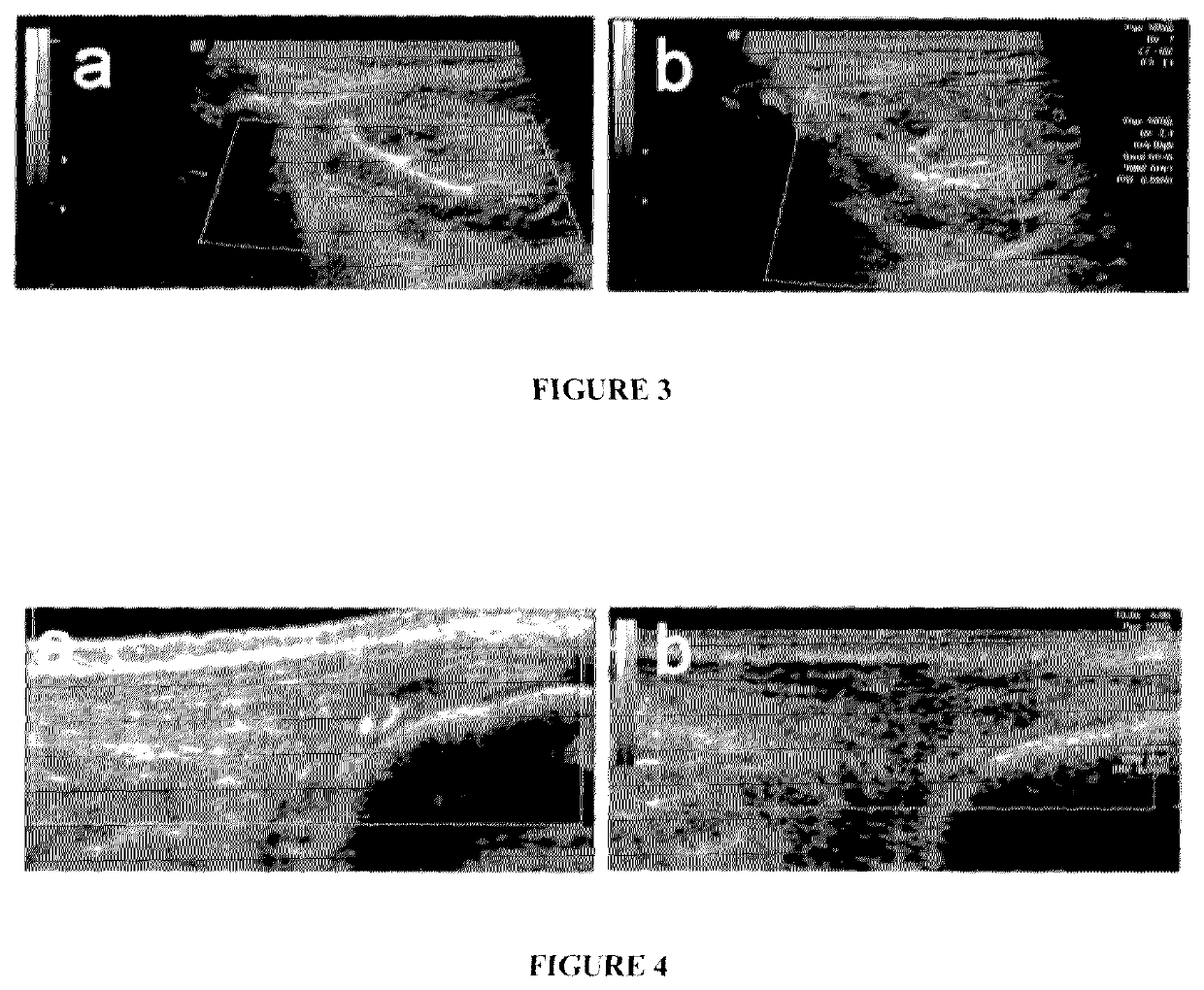 Method and composition for producing enhanced anti-inflammatory/ anti-catabolic and regenerative agents from autologous physiological fluid