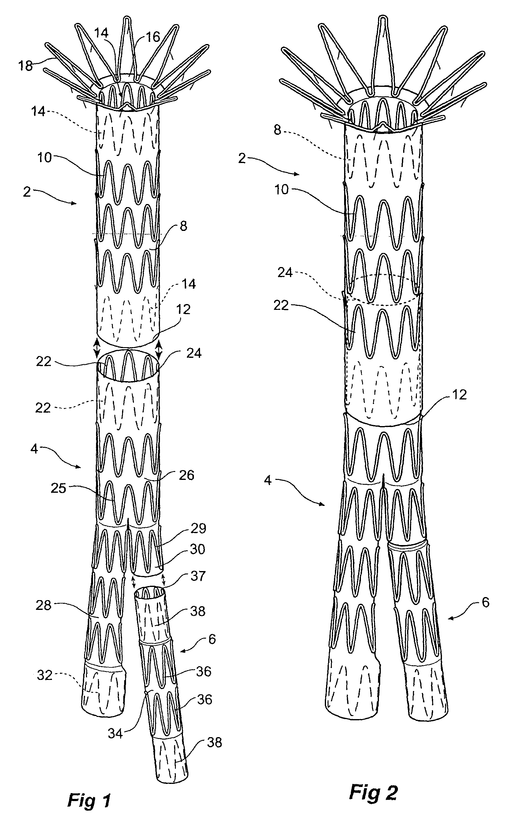 Composite prosthesis