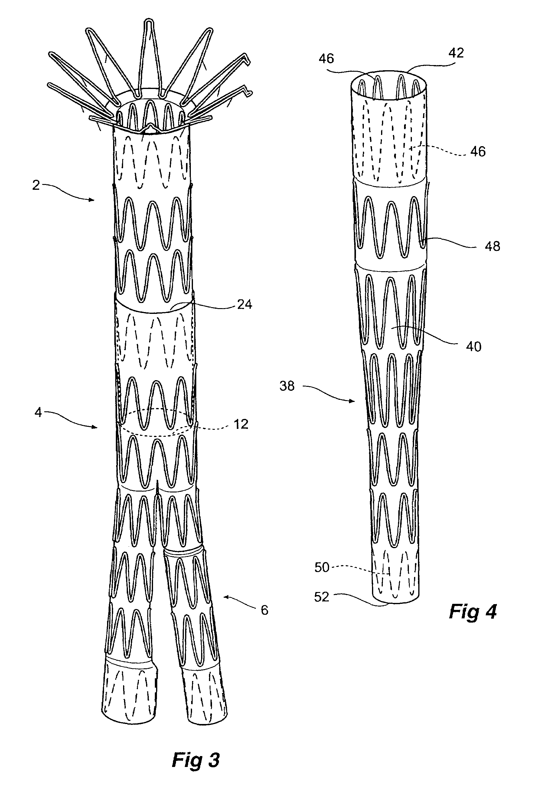 Composite prosthesis