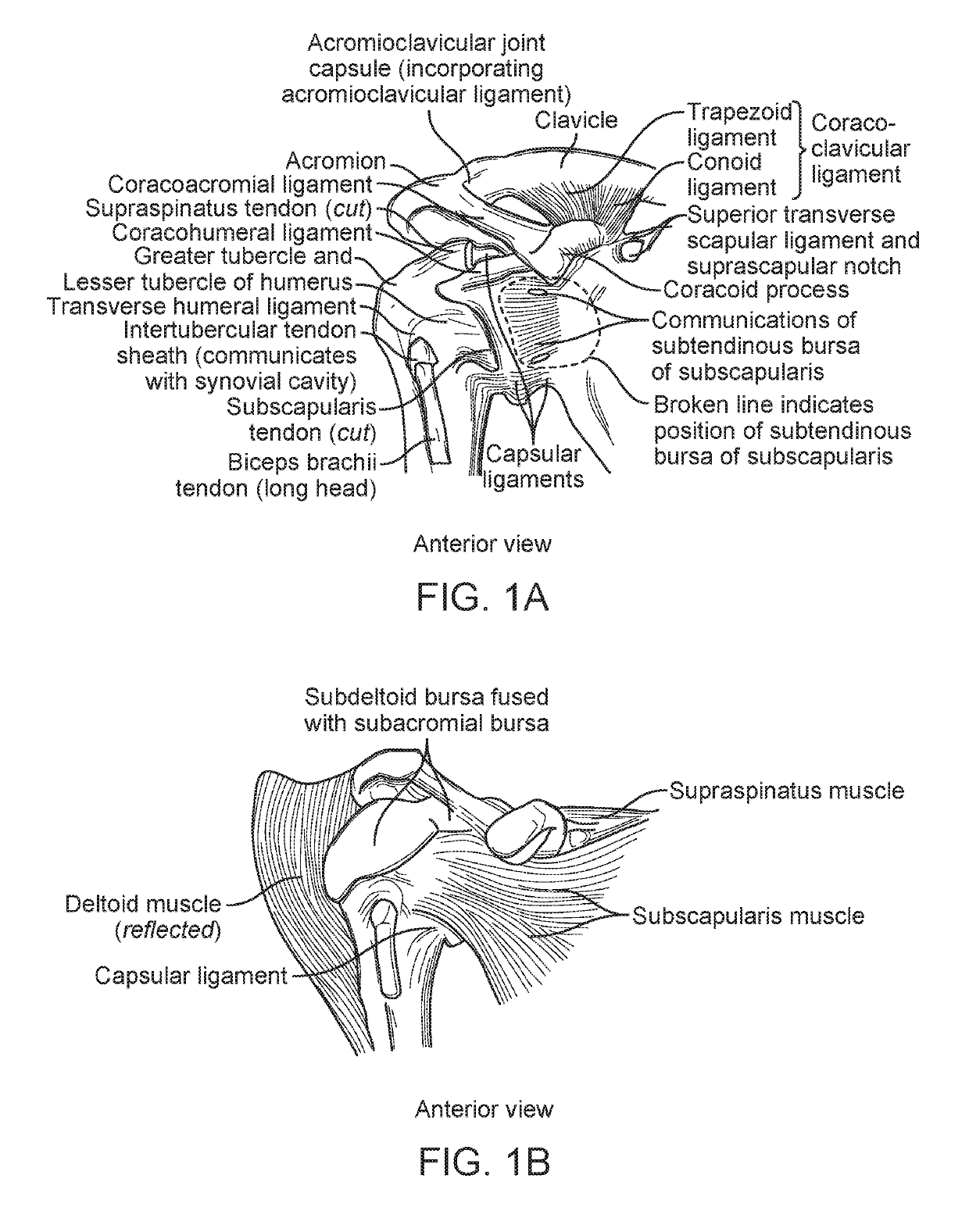 Method and apparatus for altering biomechanics of the shoulder