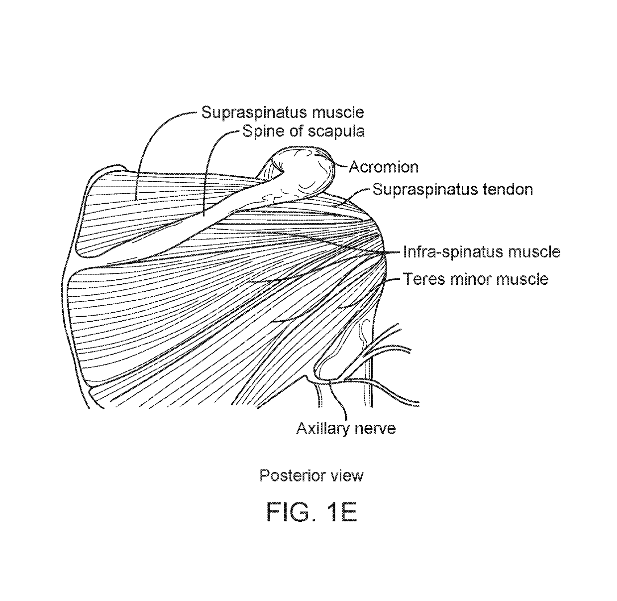 Method and apparatus for altering biomechanics of the shoulder