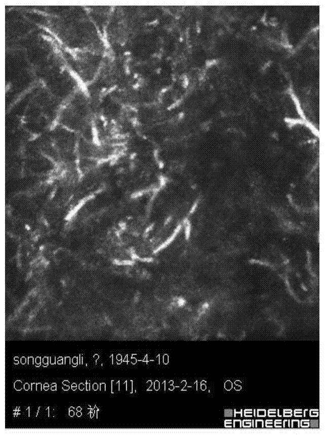 Fungal keratitis image recognition method based on RX anomaly detection and texture analysis