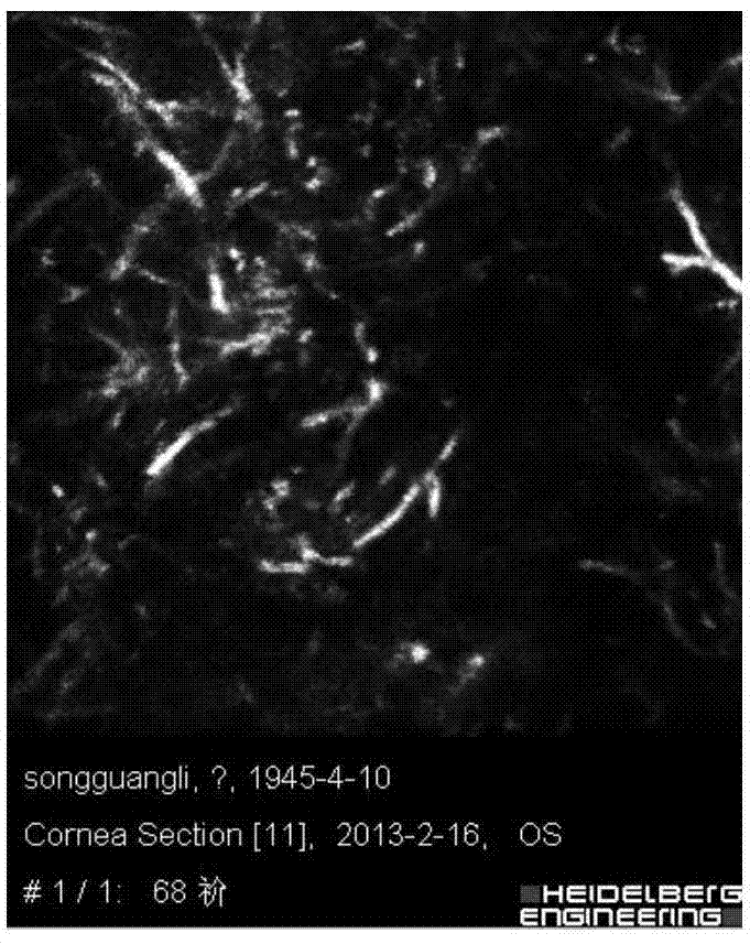 Fungal keratitis image recognition method based on RX anomaly detection and texture analysis