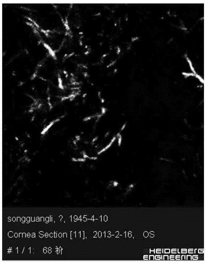 Fungal keratitis image recognition method based on RX anomaly detection and texture analysis