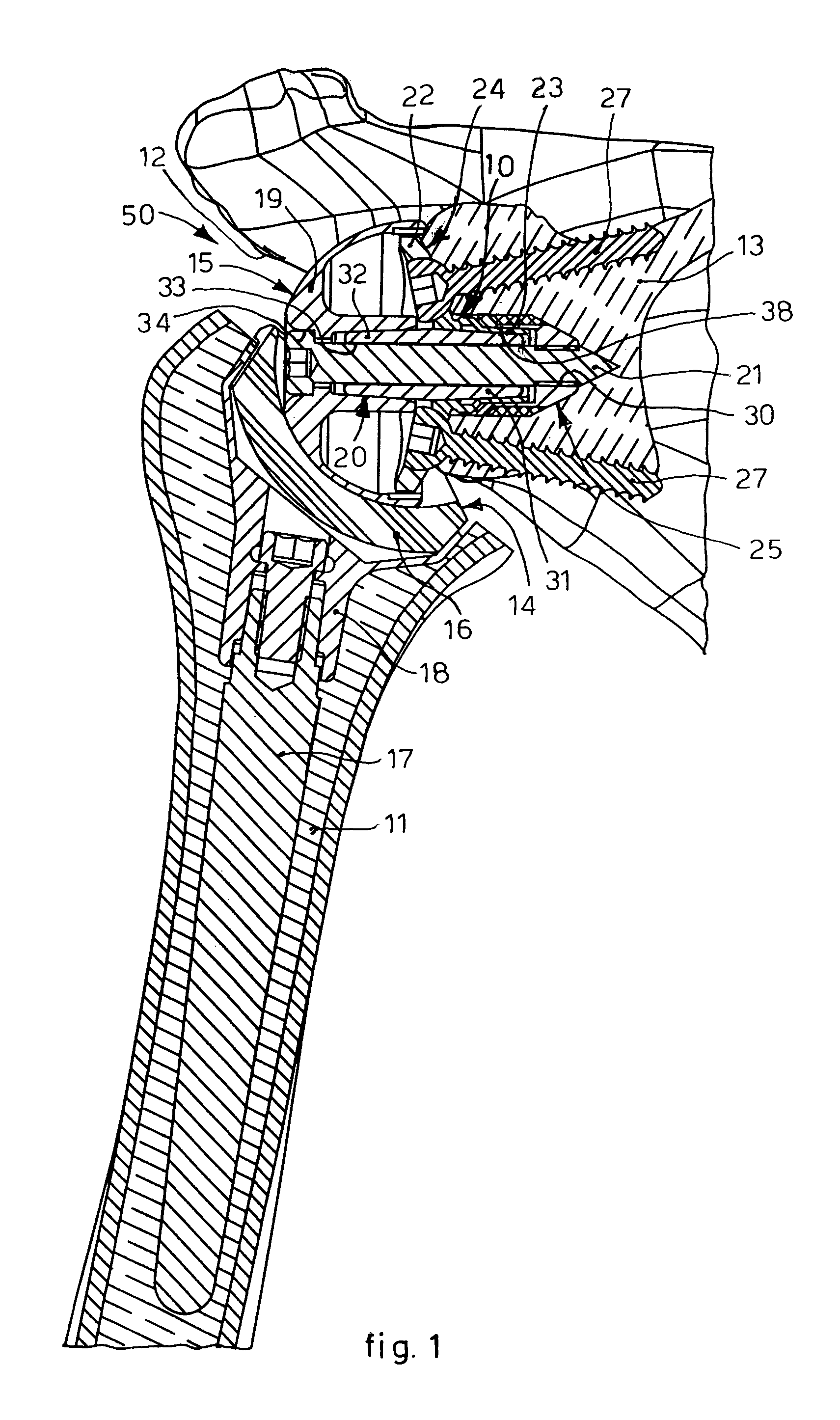 Glenoid support for shoulder prosthesis