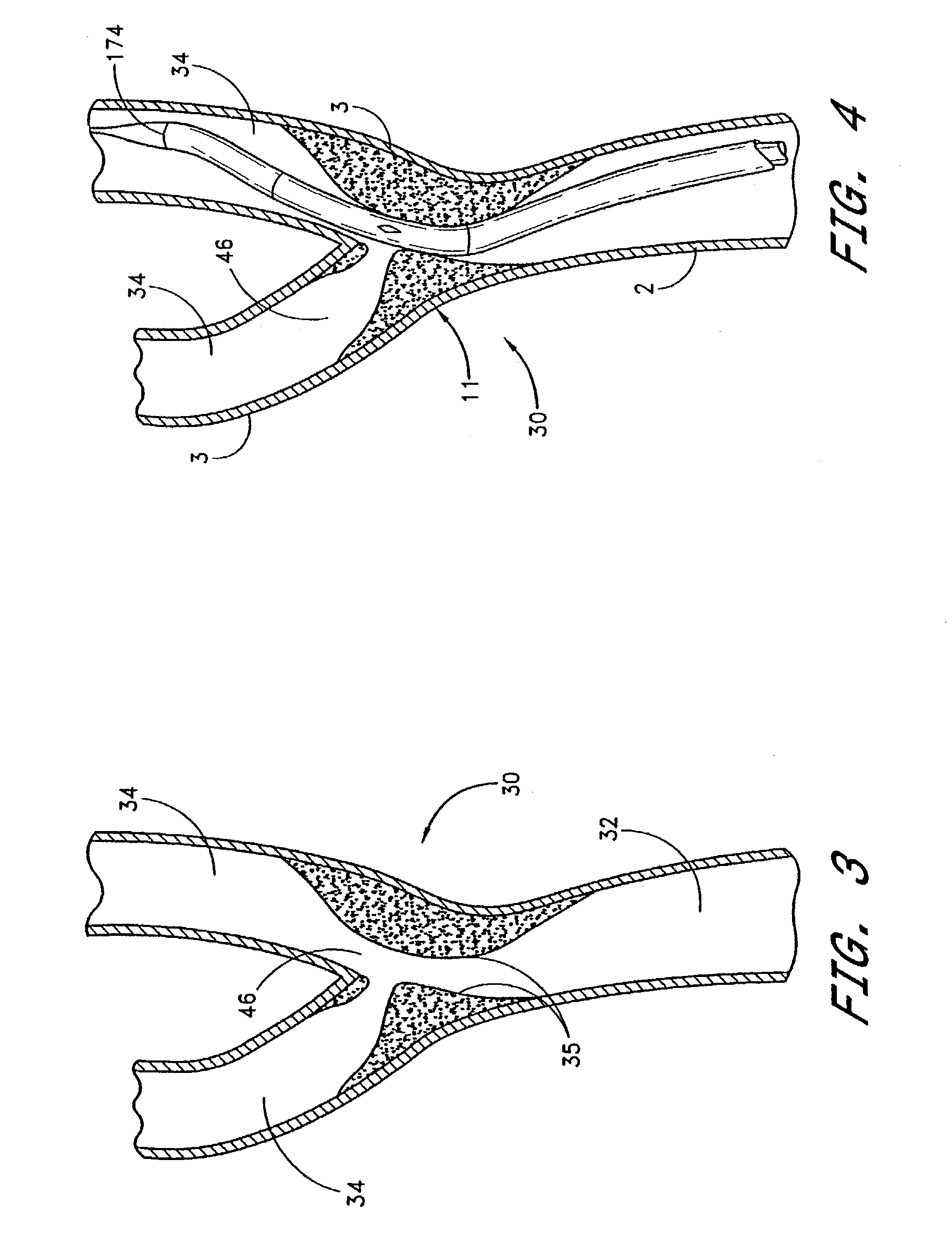 Noncylindrical stent deployment for treating vascular bifurcations