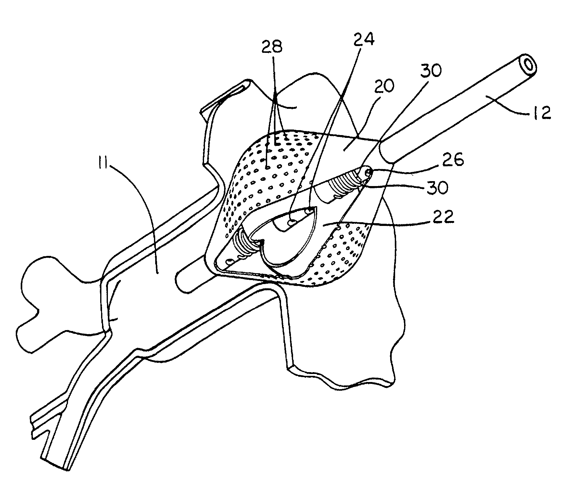 Process and device for the treatment of atrial arrhythmia