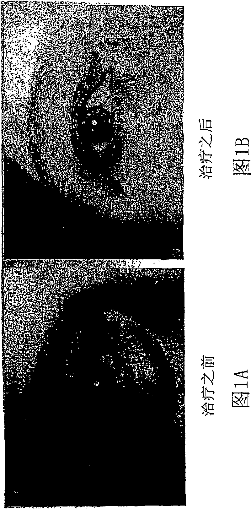 Cosmetic laser treatment device and method for localized lipodystrophies and flaccidity