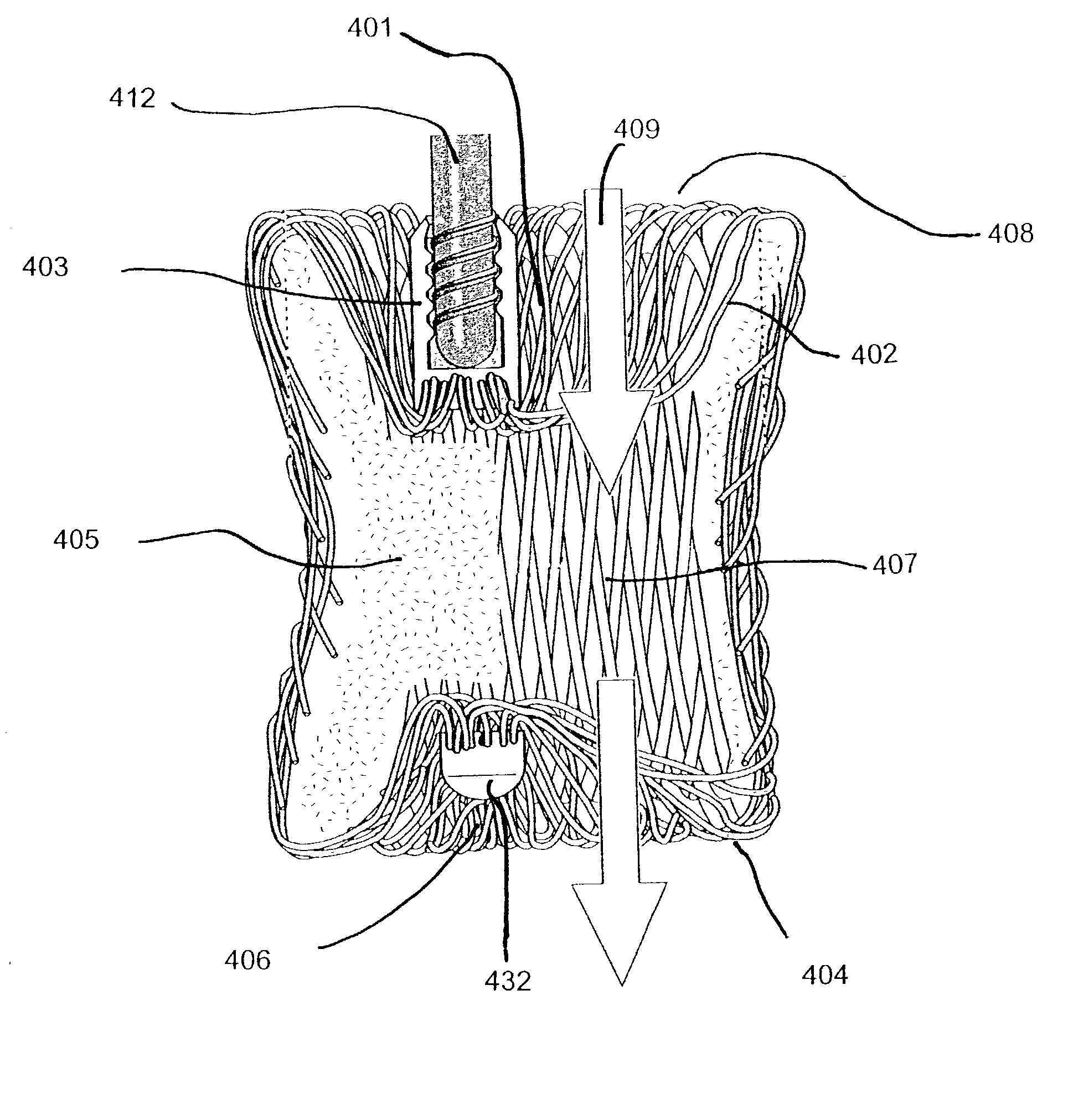 Catheter deployed partial occlusion devices and methods