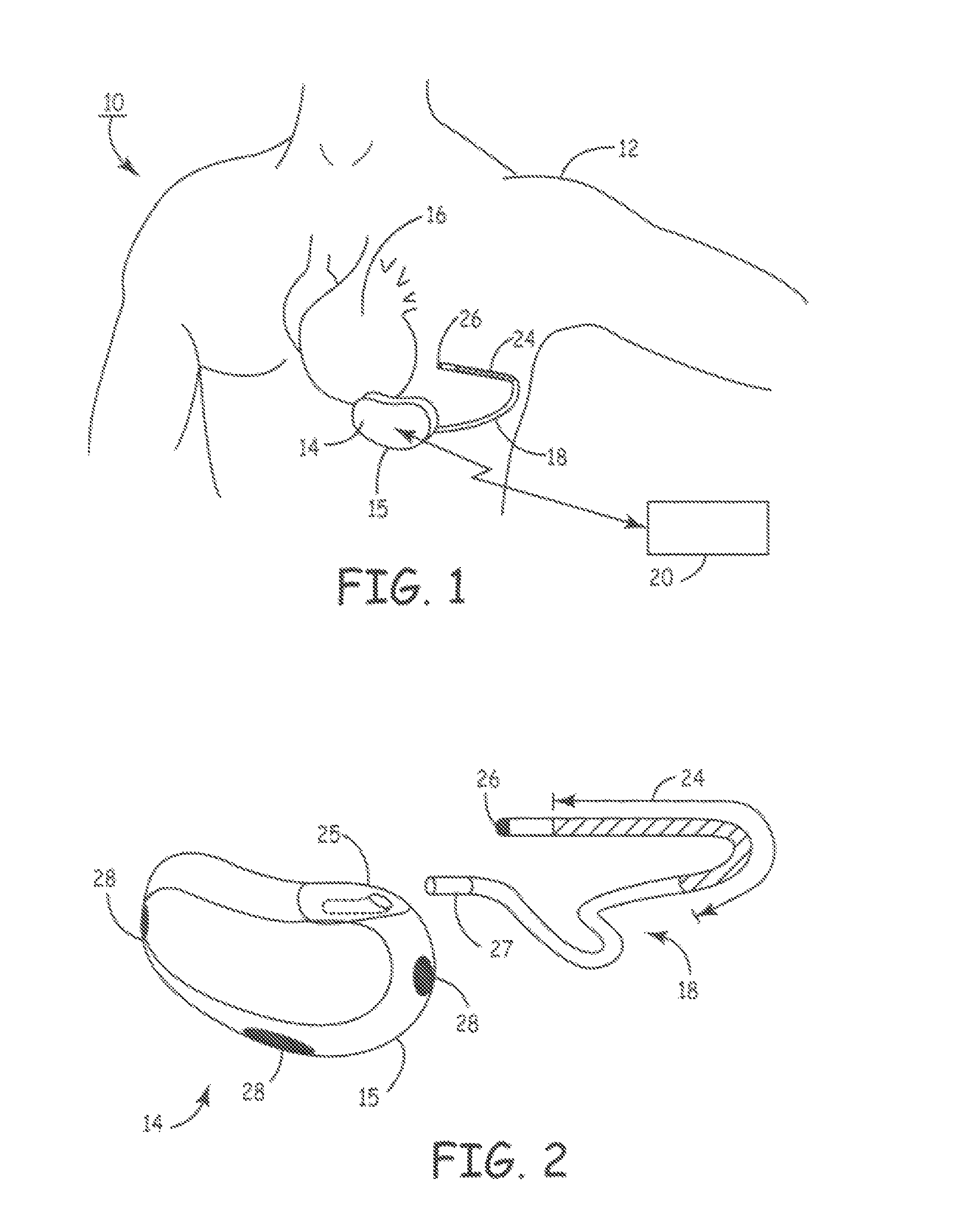 Method and apparatus for detecting arrhythmias in a subcutaneous medical device