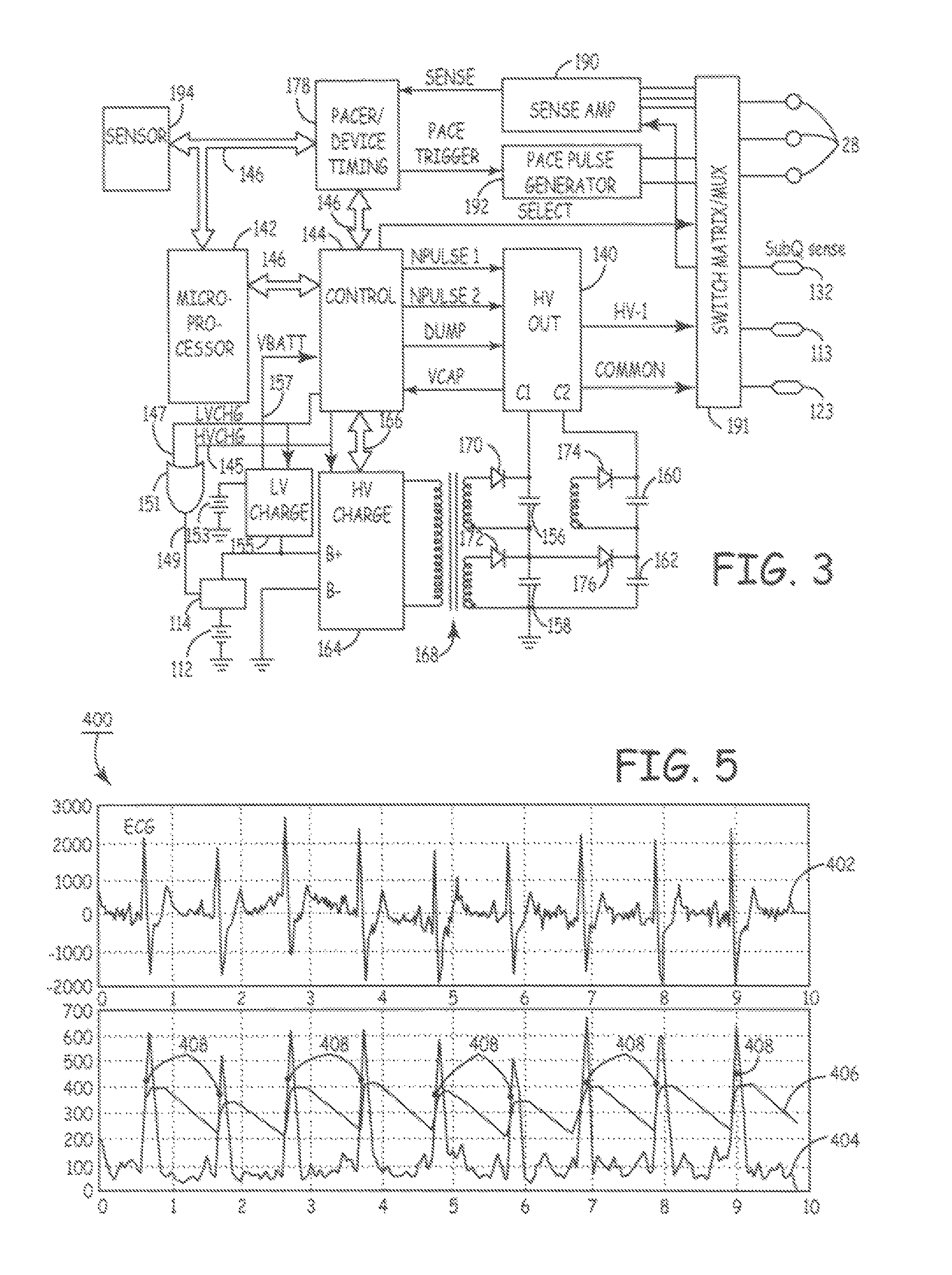 Method and apparatus for detecting arrhythmias in a subcutaneous medical device