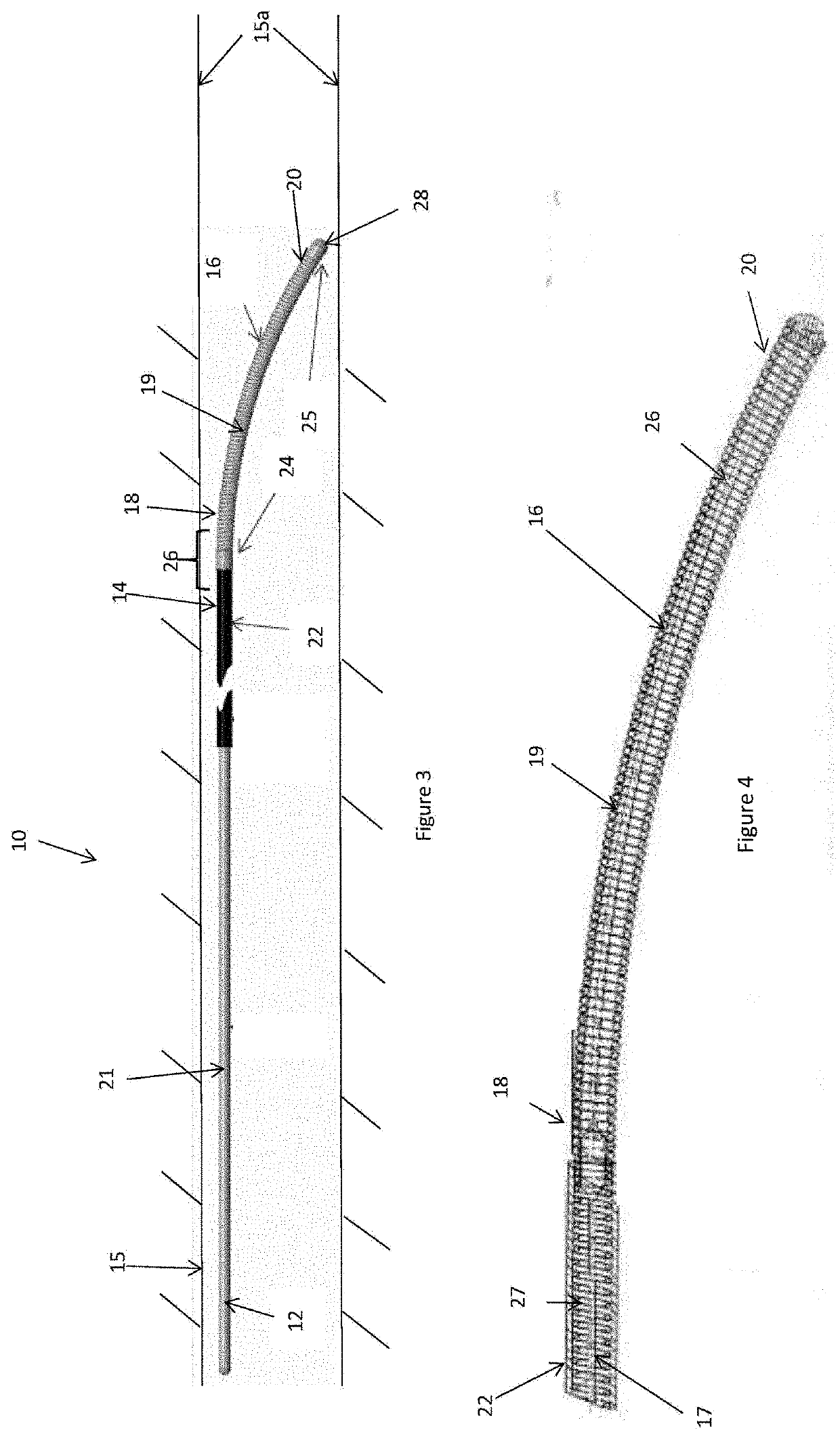 Energy delivery device for endovascular occlusion