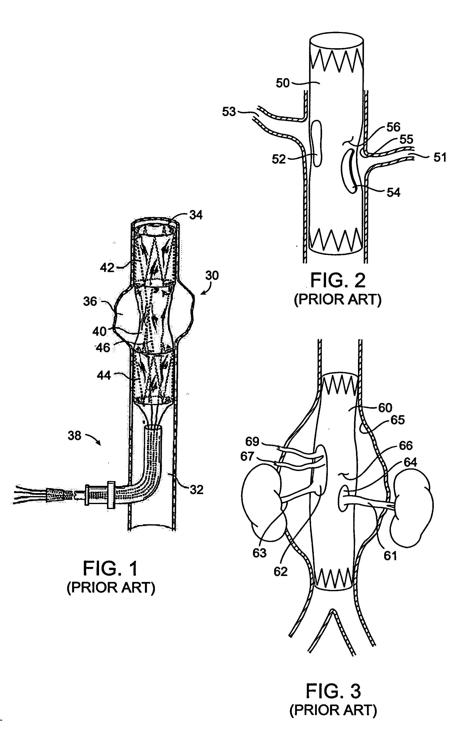 Branch vessel graft design and deployment method