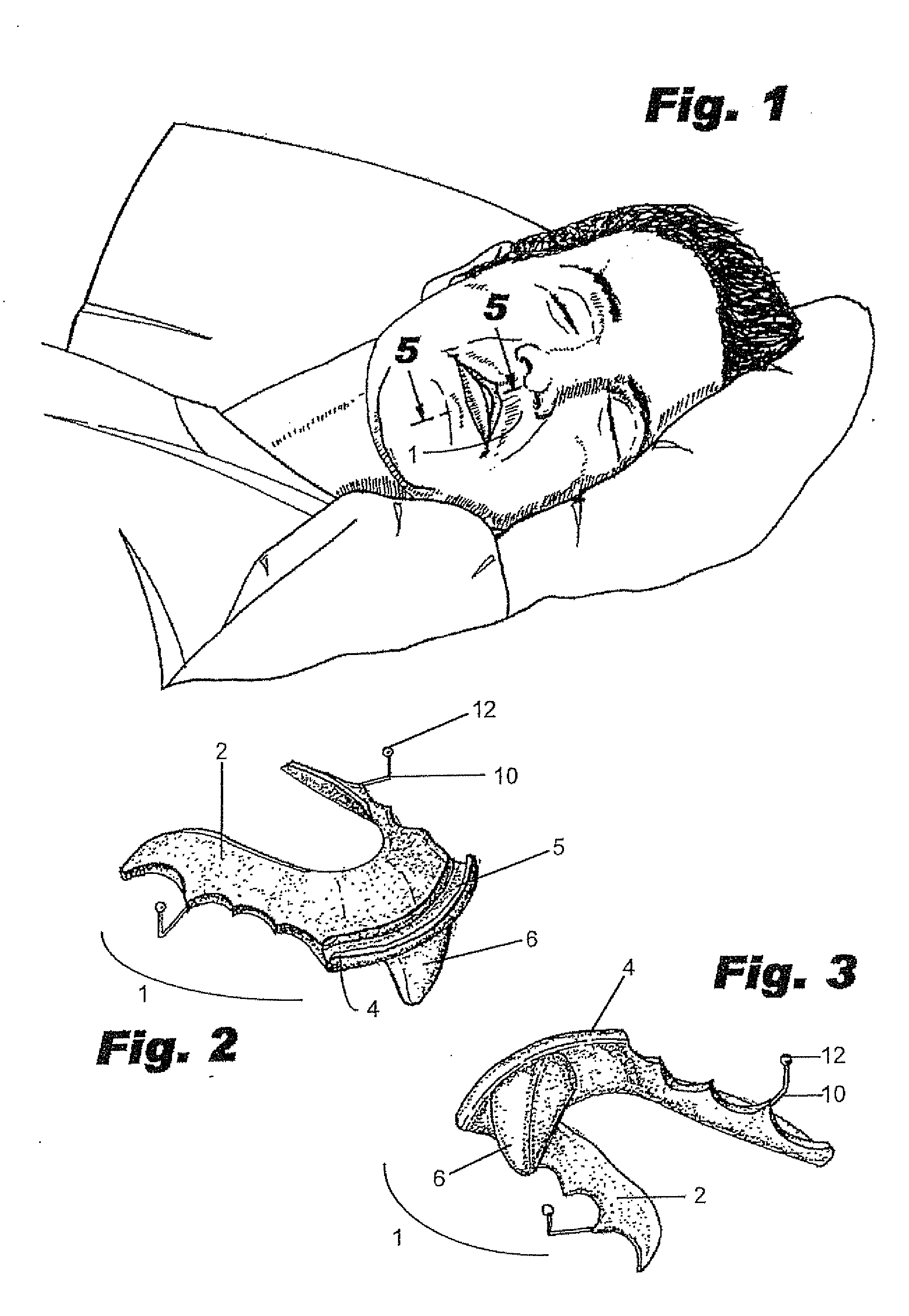 Intraoral mandibular advancement device for treatment of sleep disorders