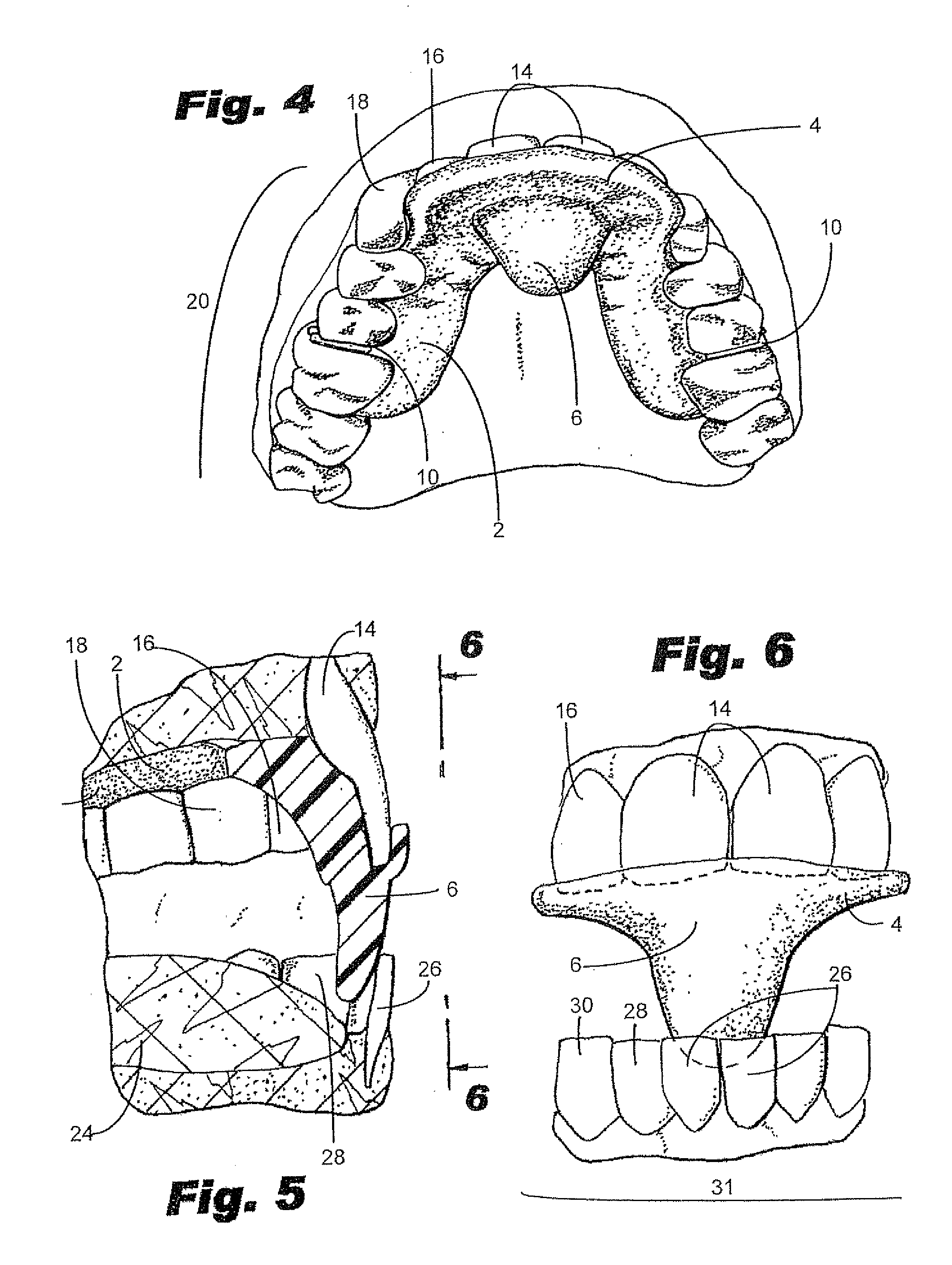 Intraoral mandibular advancement device for treatment of sleep disorders