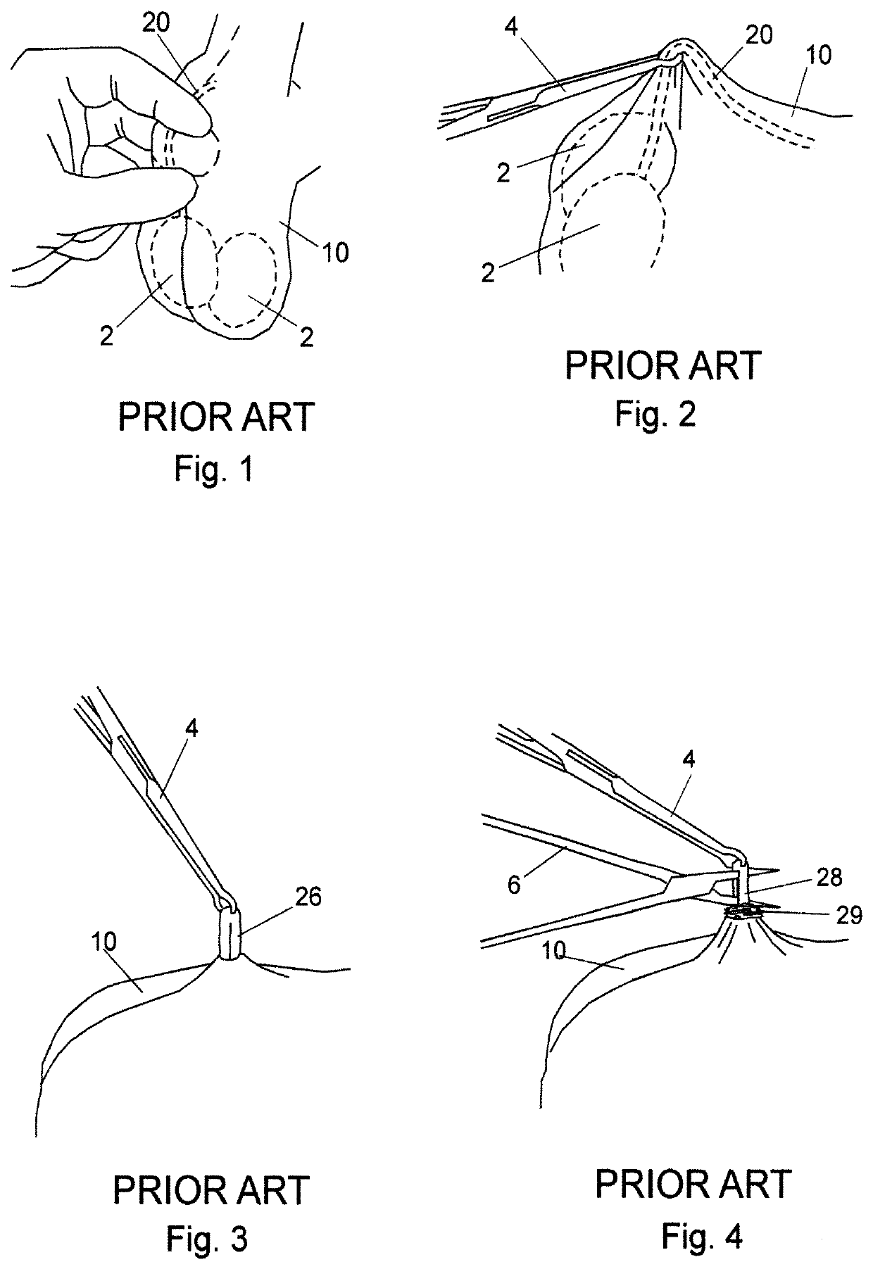 Vasectomy devices and methods for their use