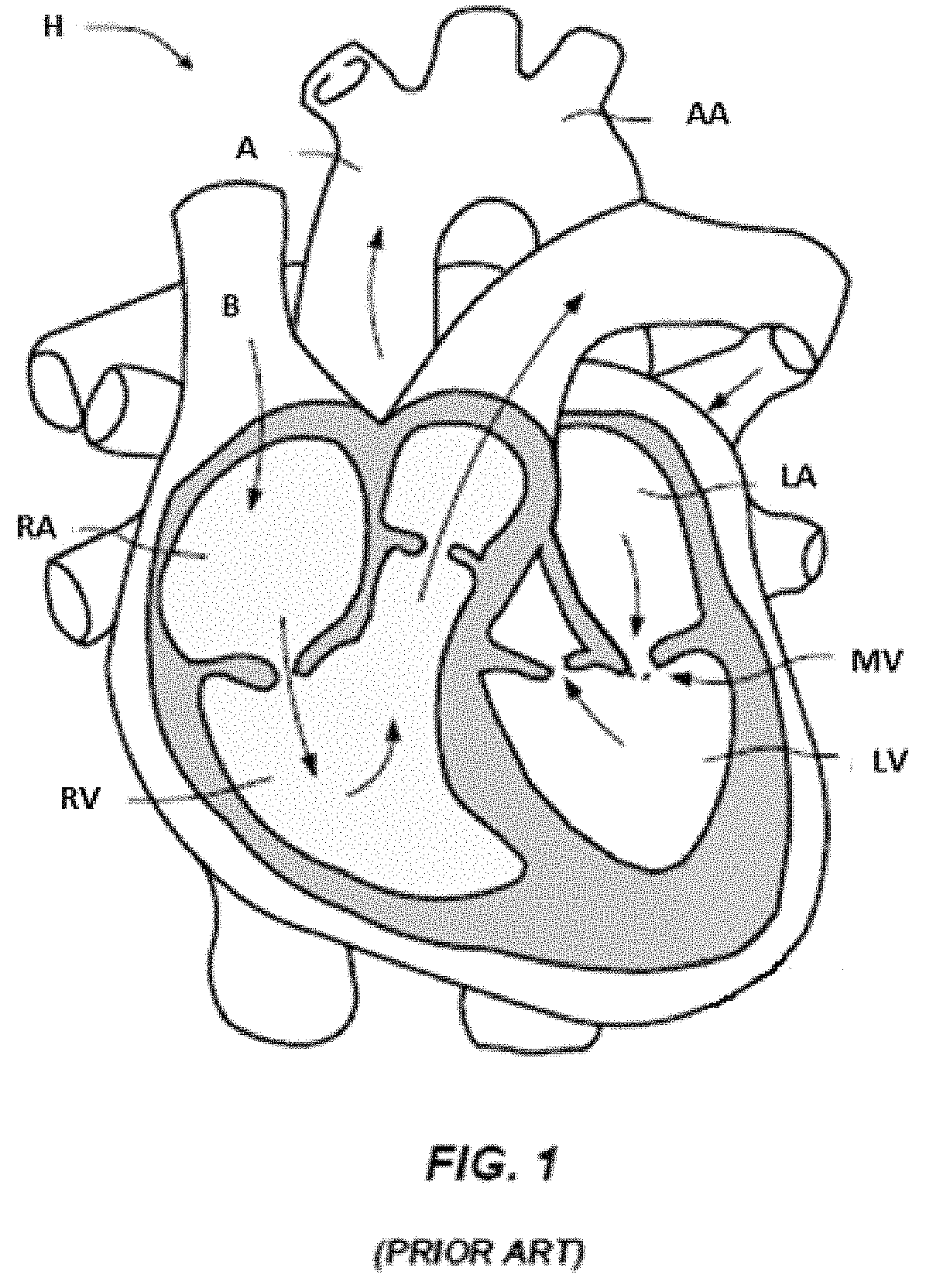 Heart valve with chordal capture elements for stabilization