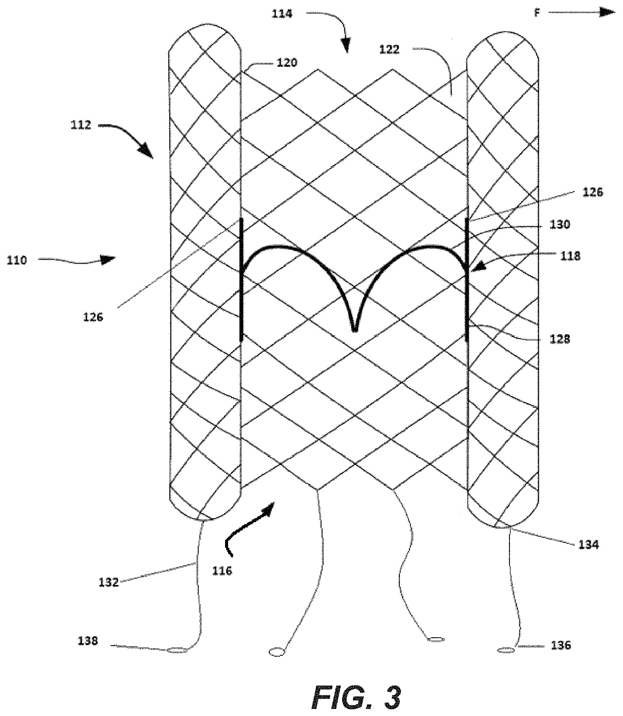 Heart valve with chordal capture elements for stabilization