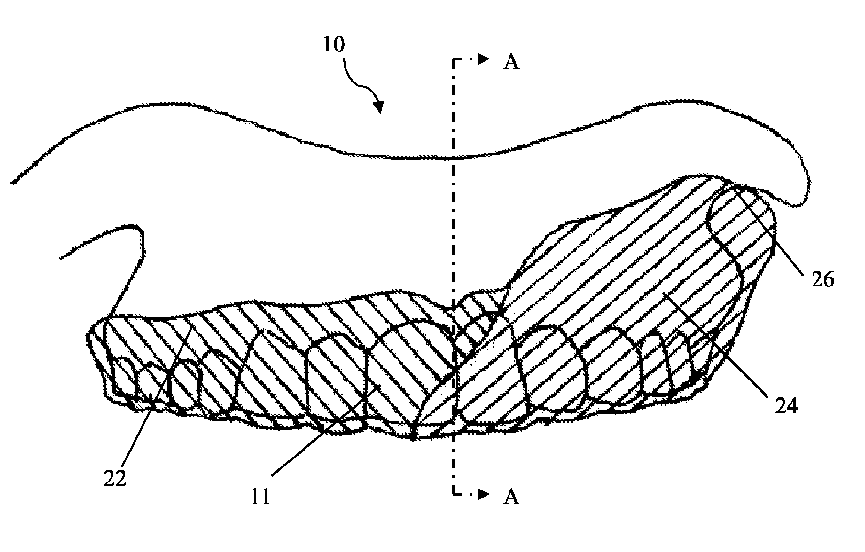 Intra-oral appliance and methods of using same