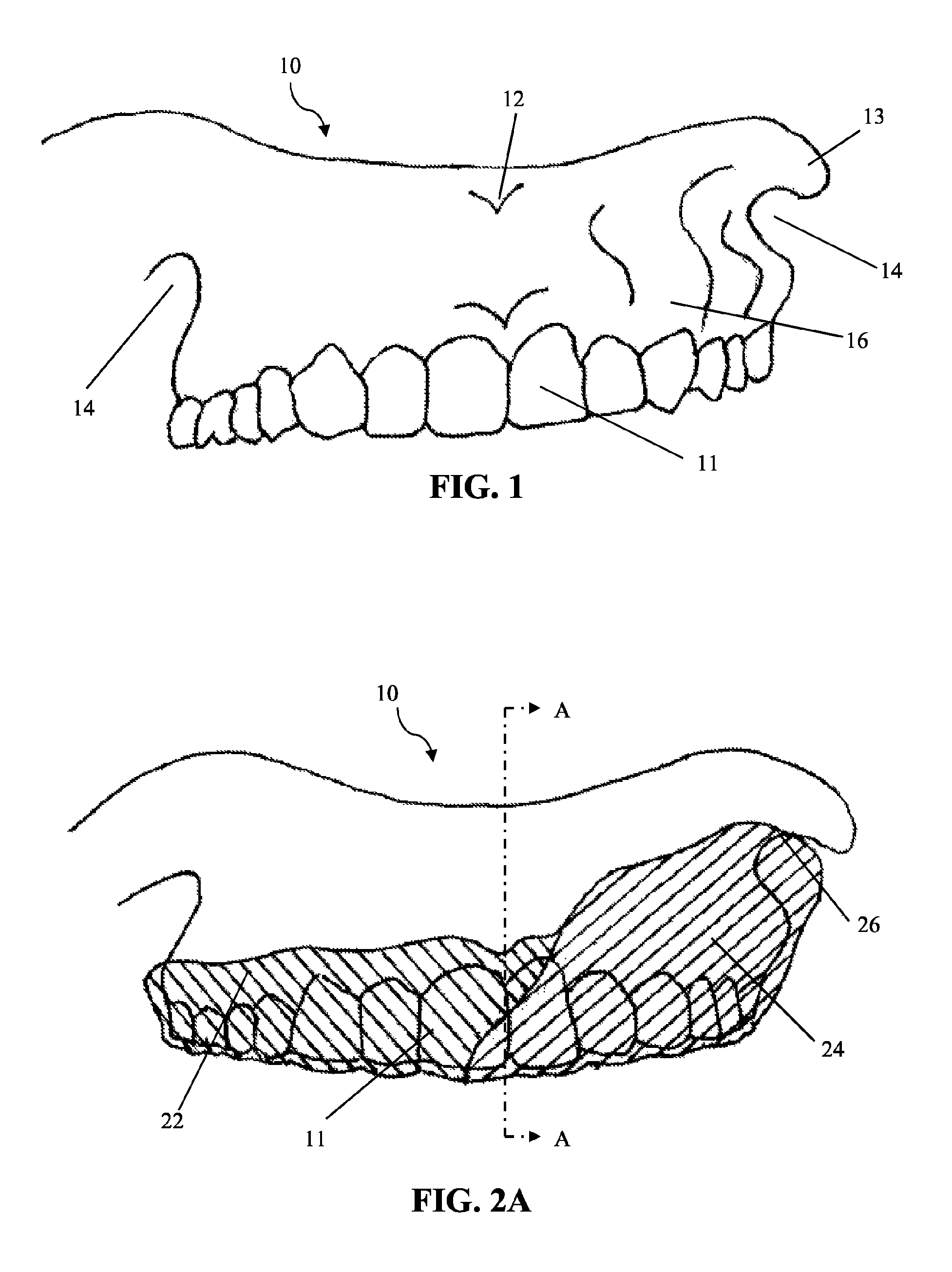 Intra-oral appliance and methods of using same