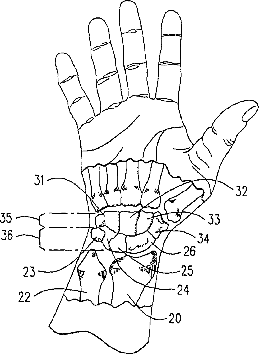 Co-dynamic adjustable orthotic appliance for carpal tunnel syndrome