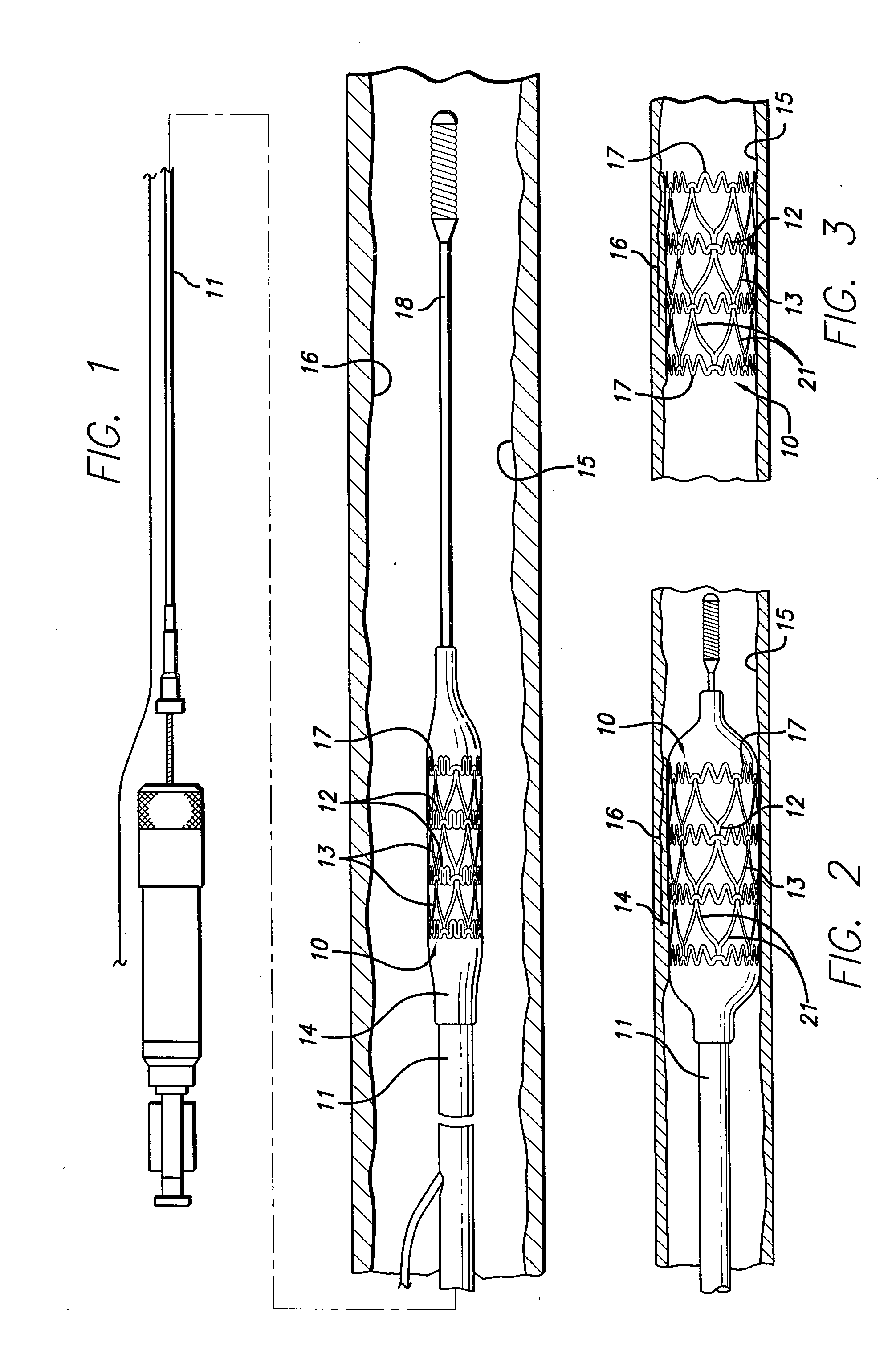 Hybrid stent and method of making