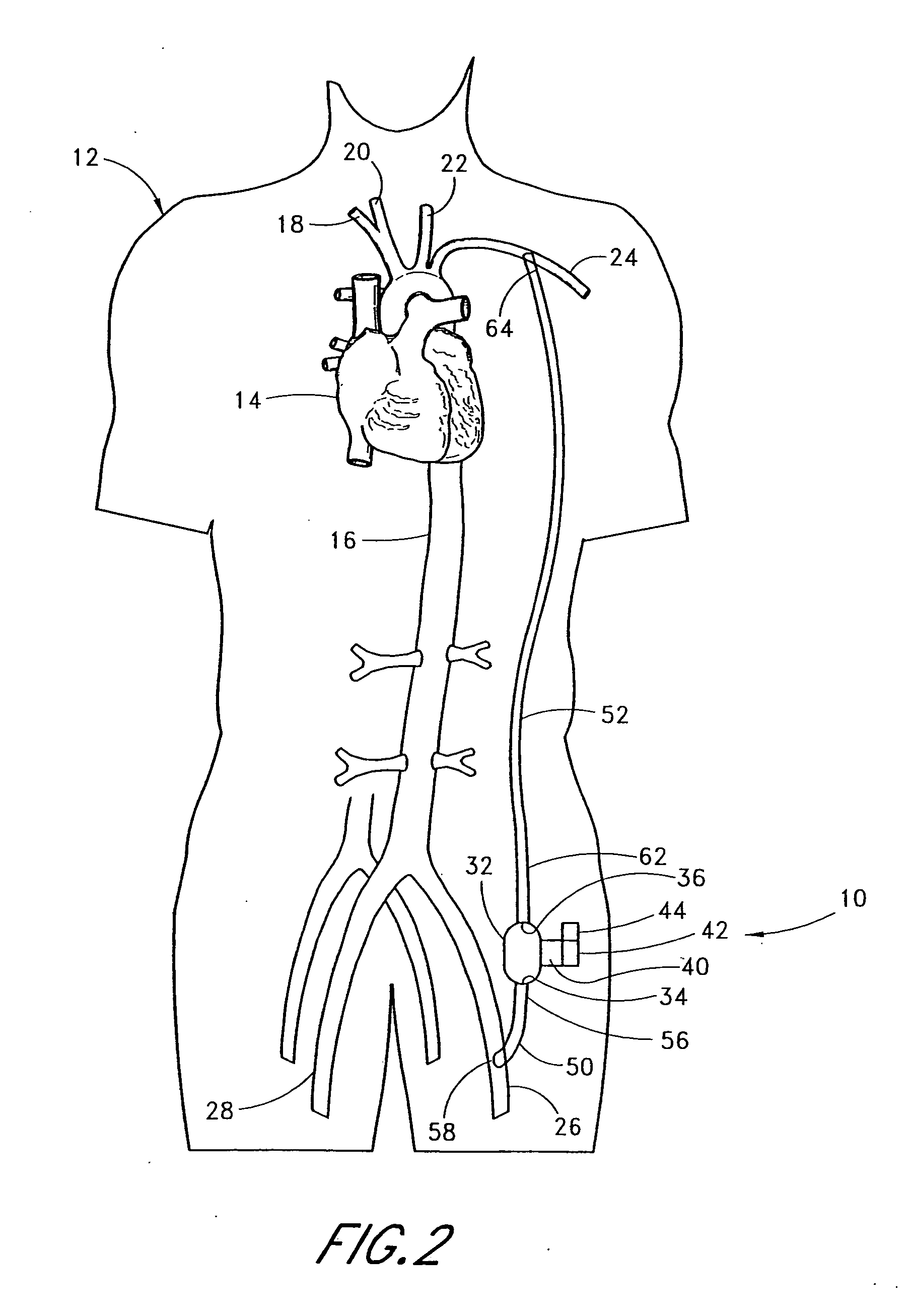 Implantable heart assist system and method of applying same