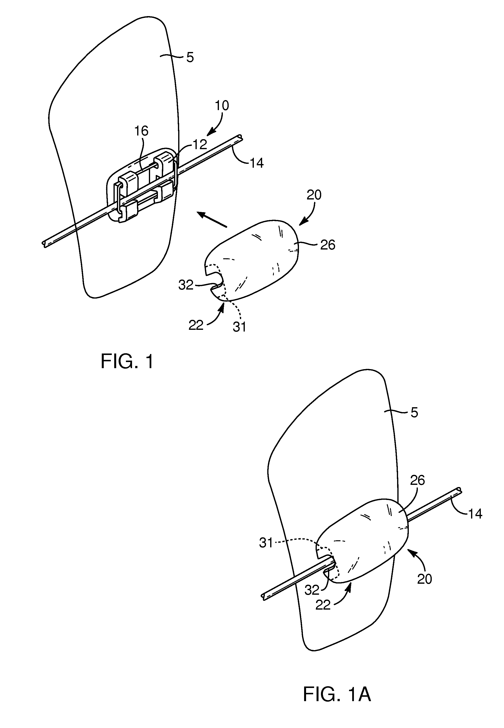 Devices, systems, and methods for orthodontic hardware