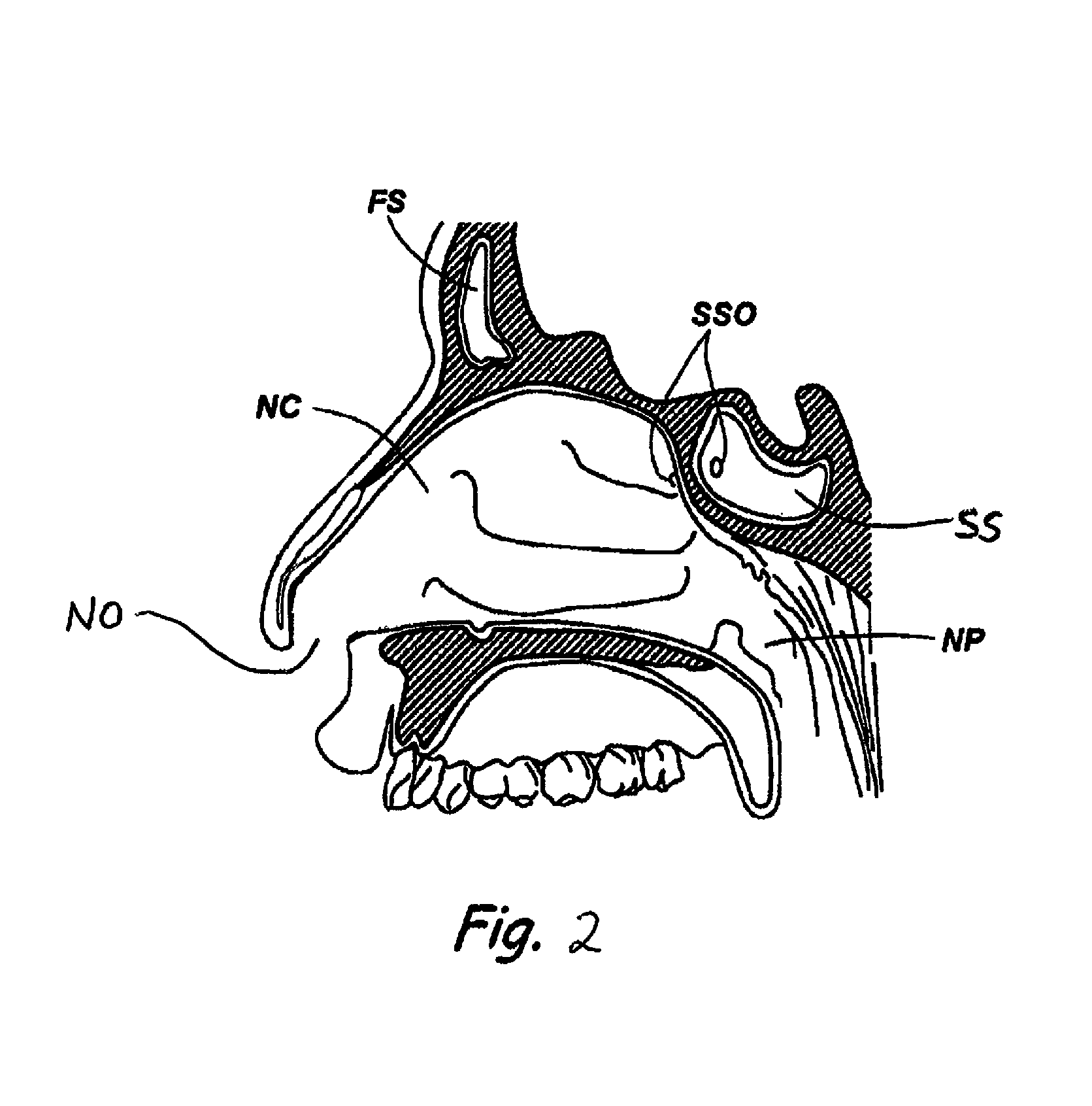 Devices and methods for inserting a sinus dilator