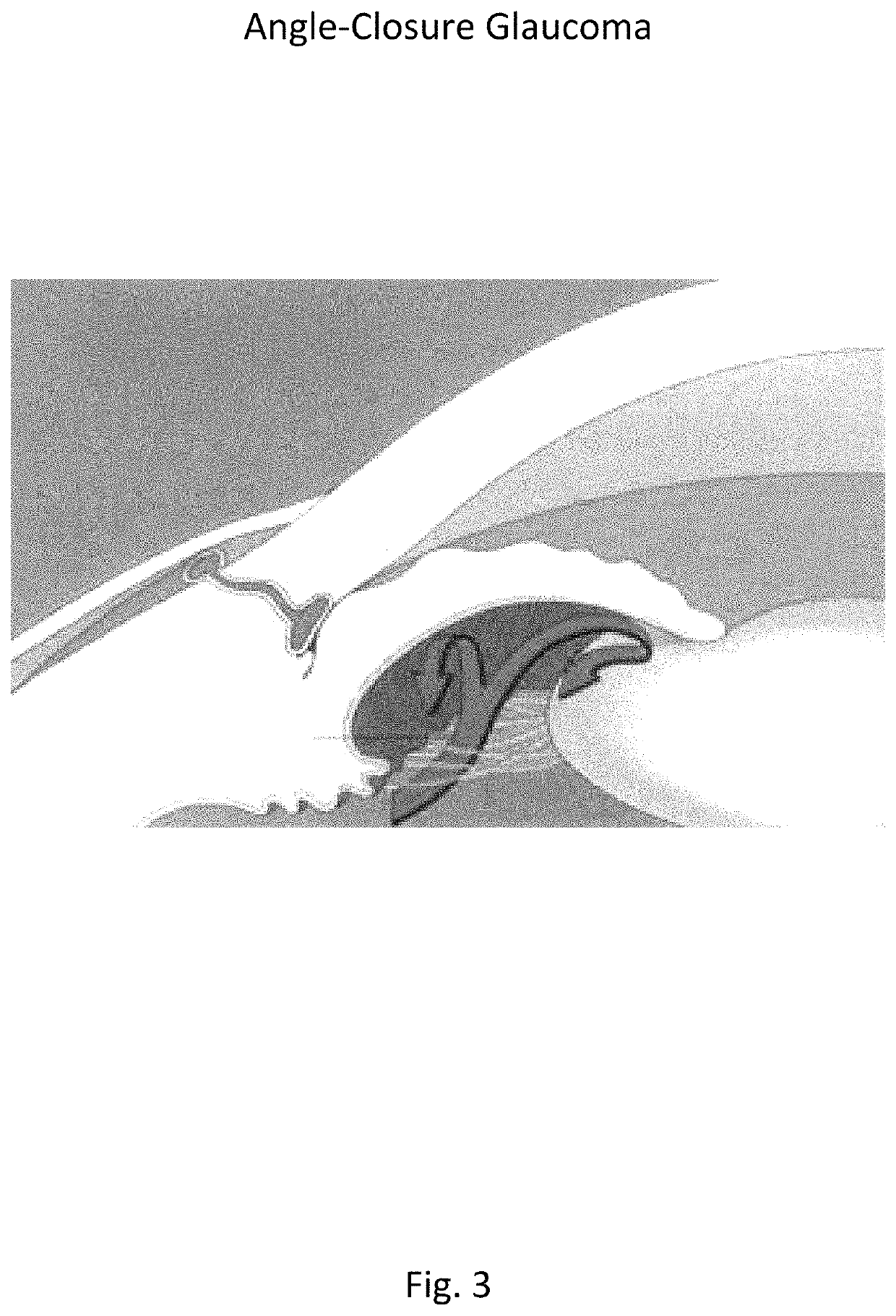 Method for laser treatment for glaucoma