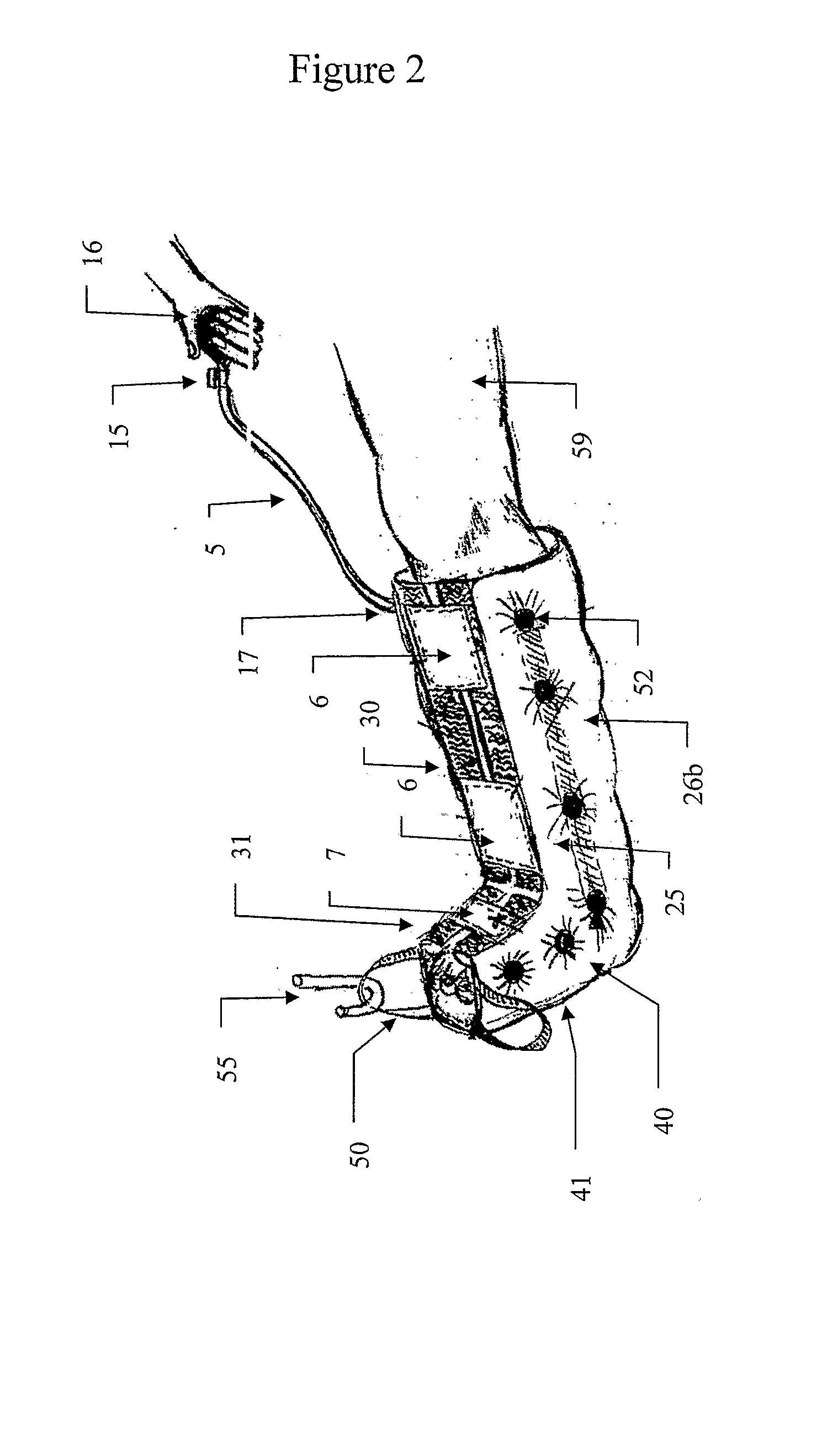 Immobilizing and Supporting Inflatable Splint Apparatus