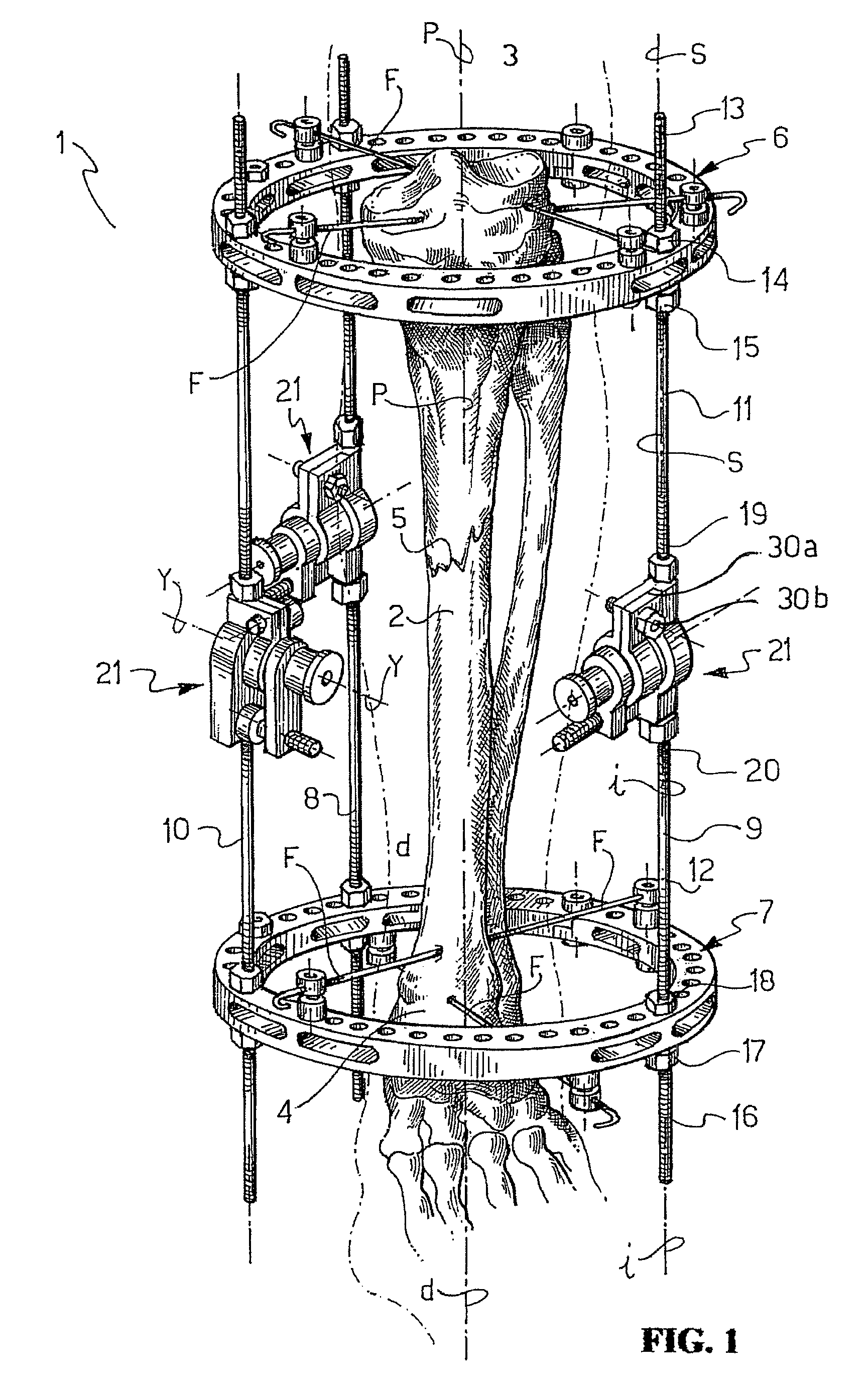 Ring fixator